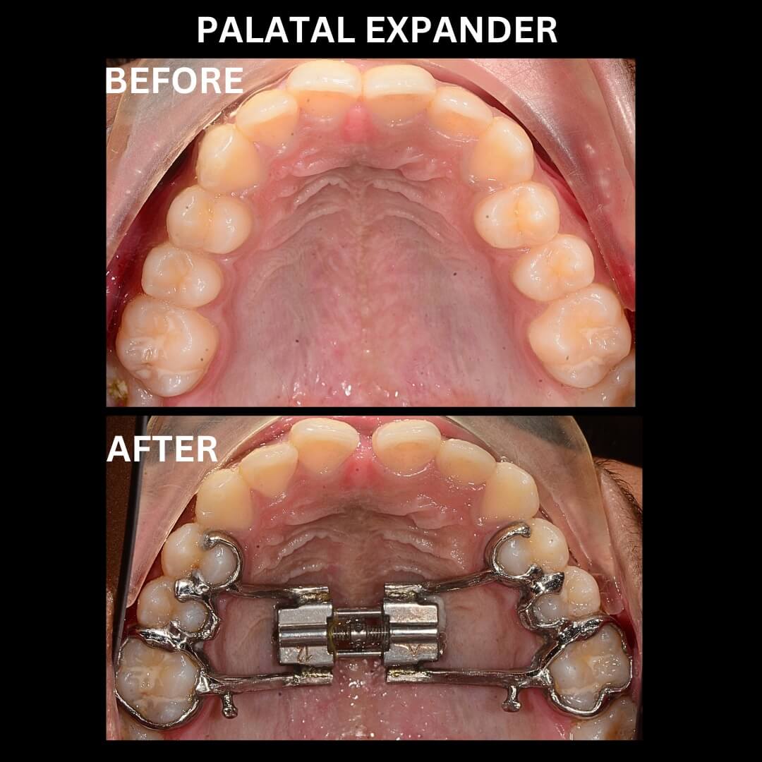 Palate Widening Orthodontics