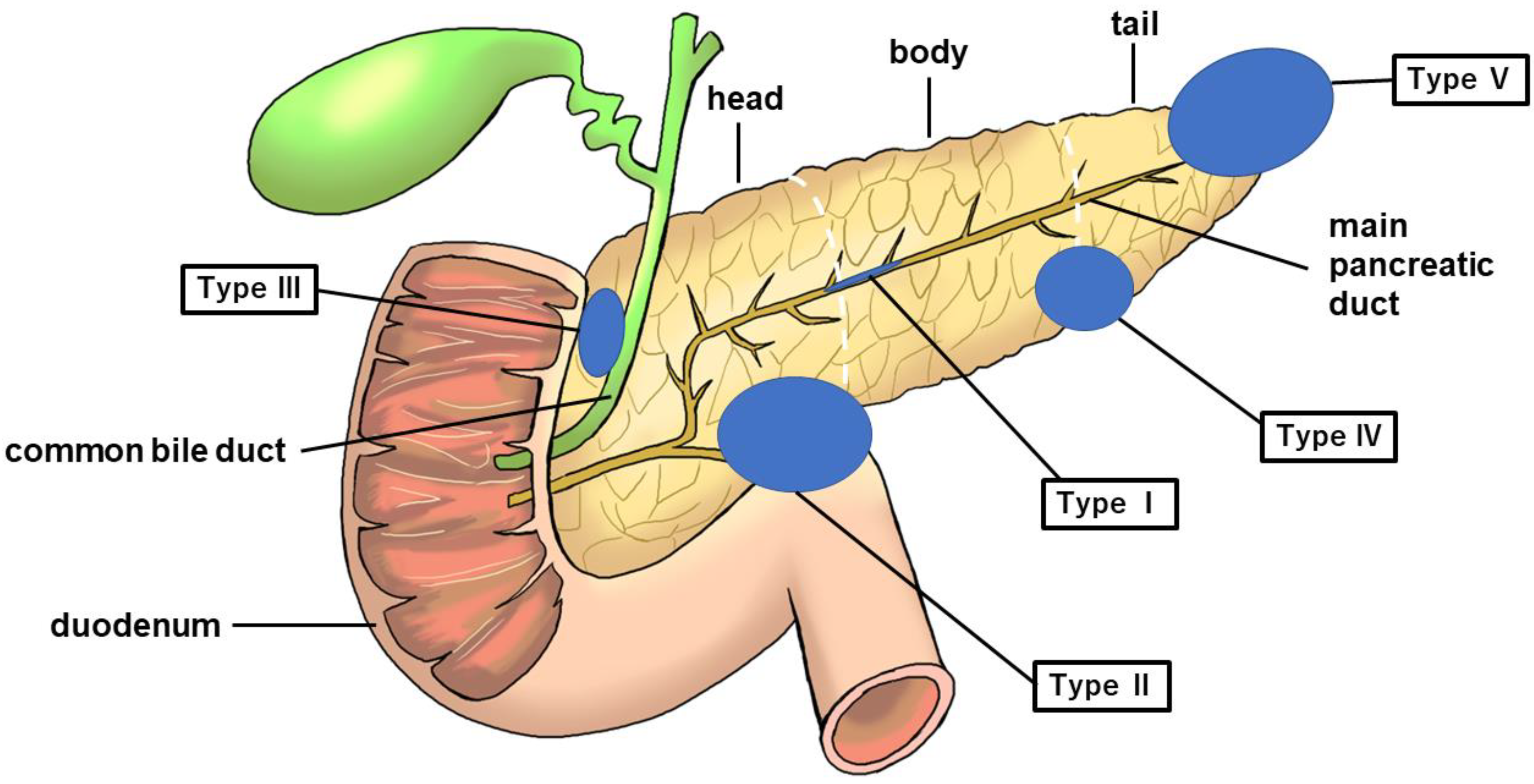 Pancreatic Duct Dilation