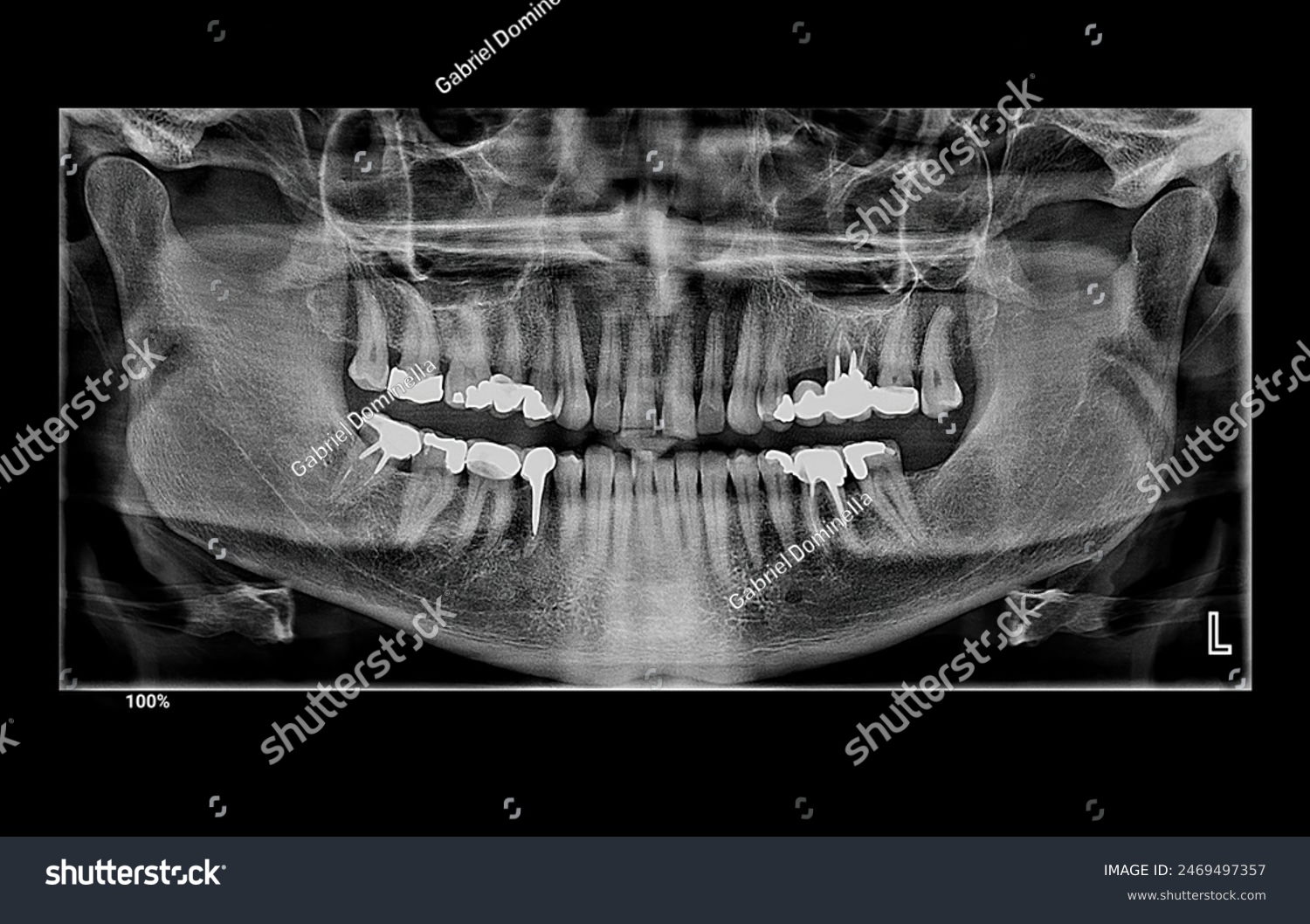 Panoramic Dental X Ray