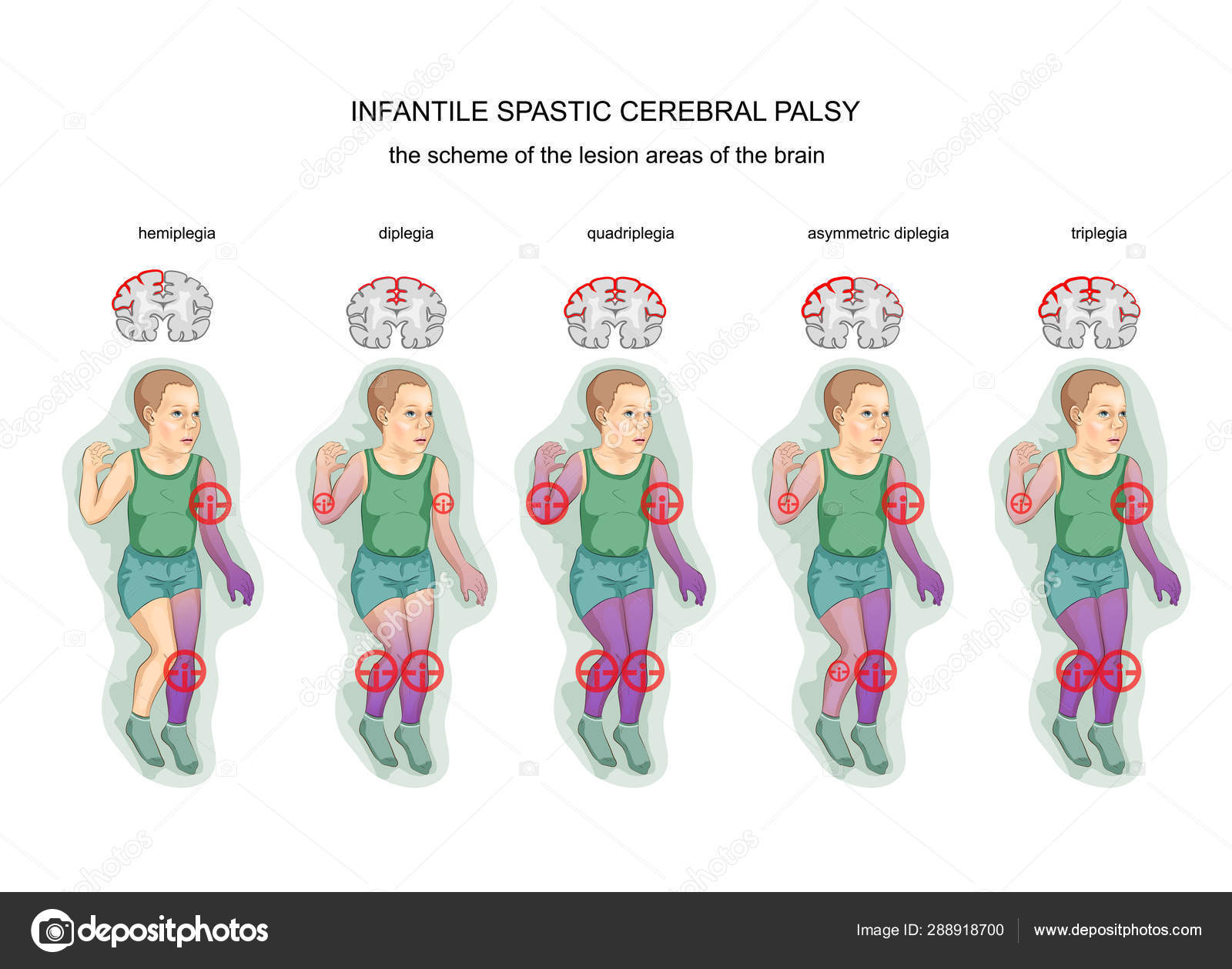 Paralisis Cerebral Infantil