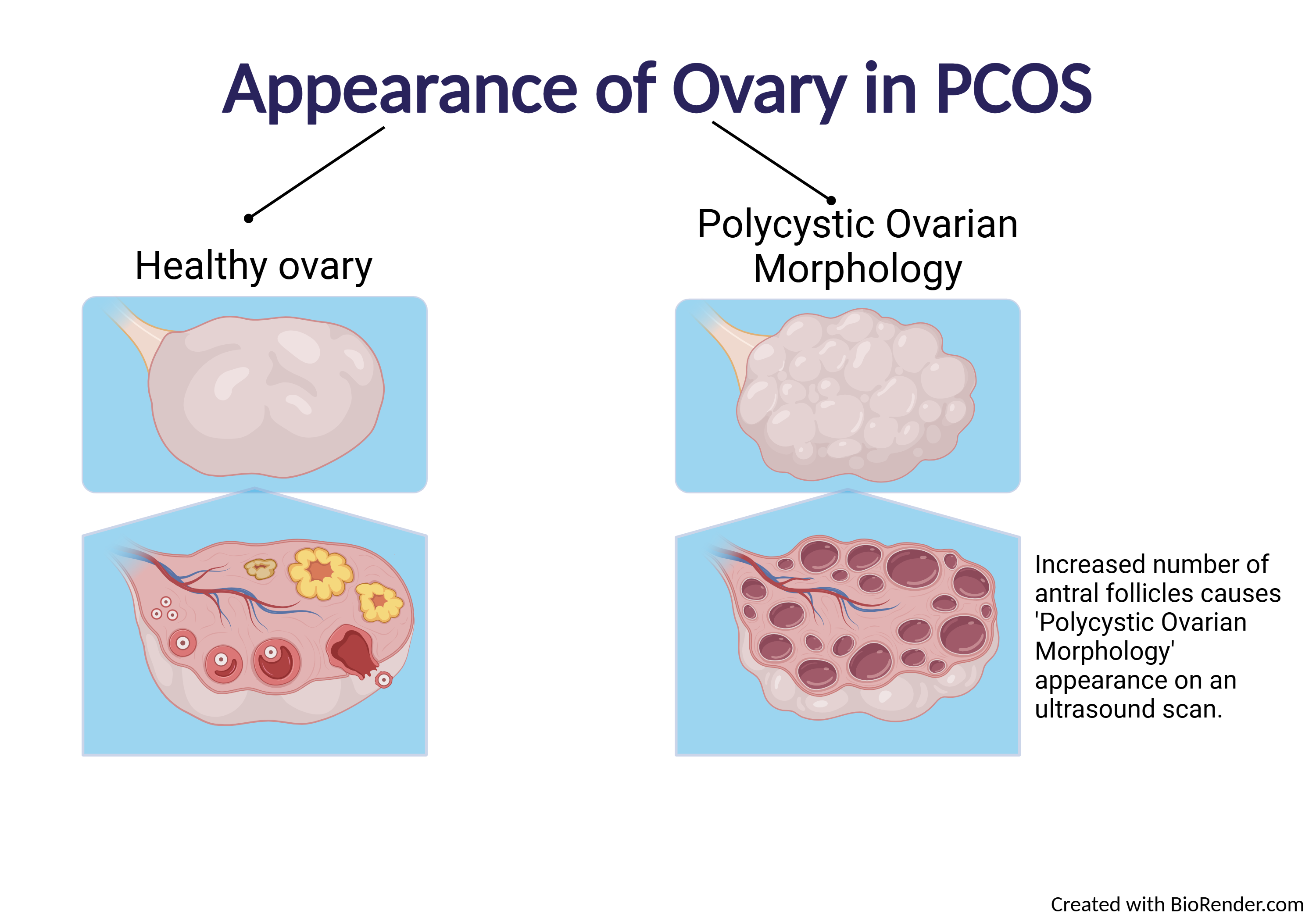 Pcos Image In Ultrasound
