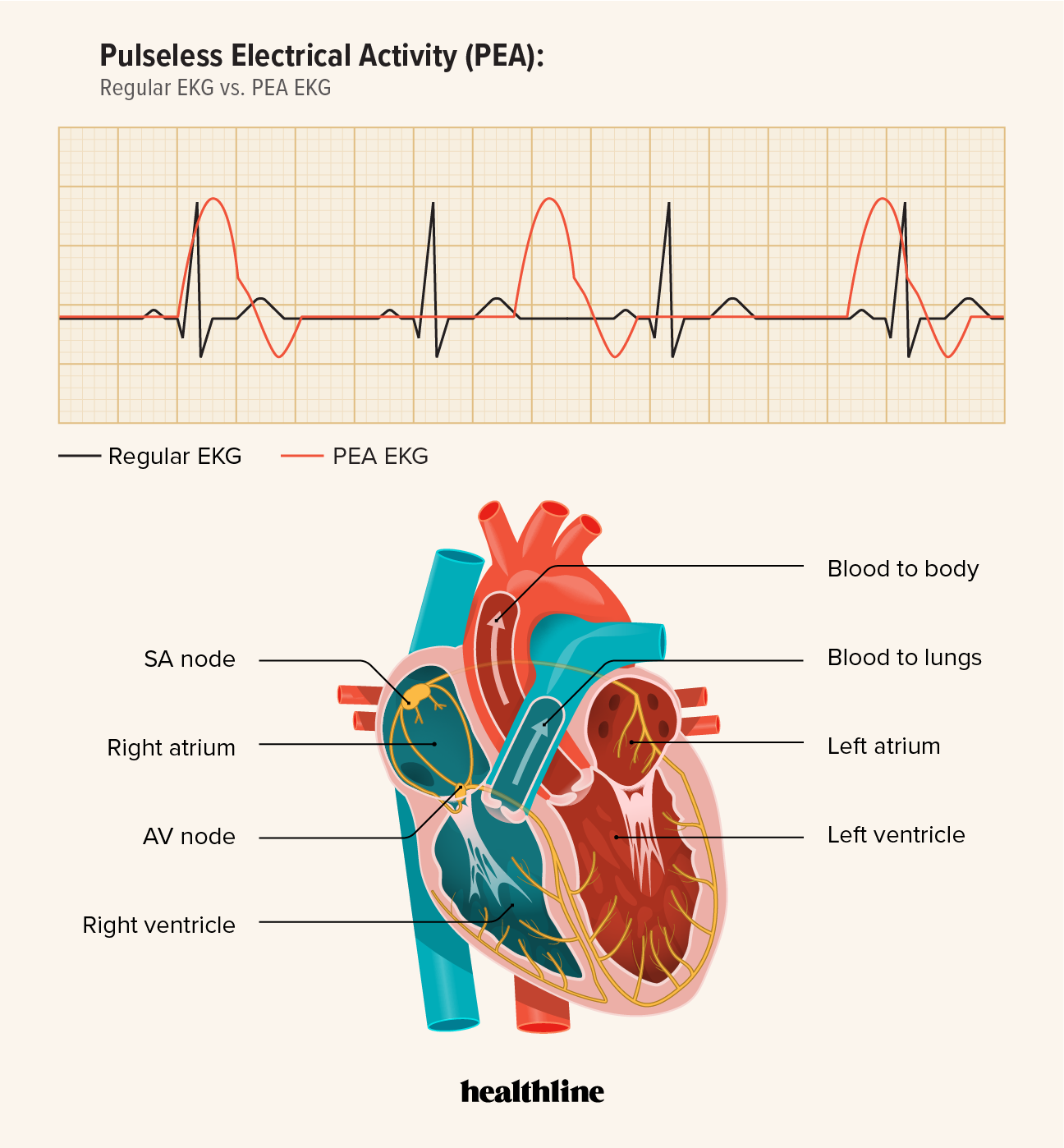 Pea Cardiac Arrest