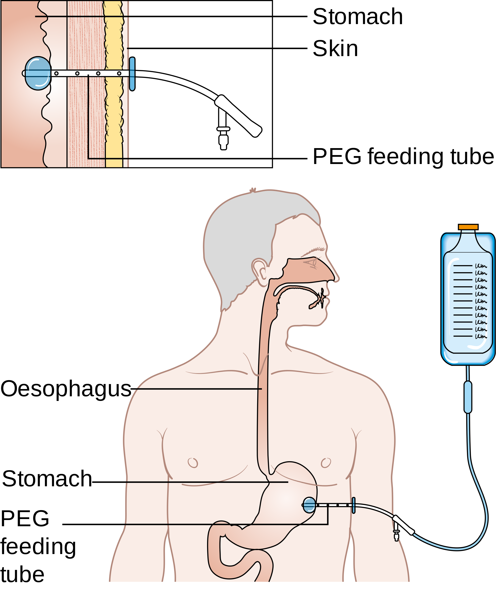 Peg Gastric Feeding Tube - Face Surgery