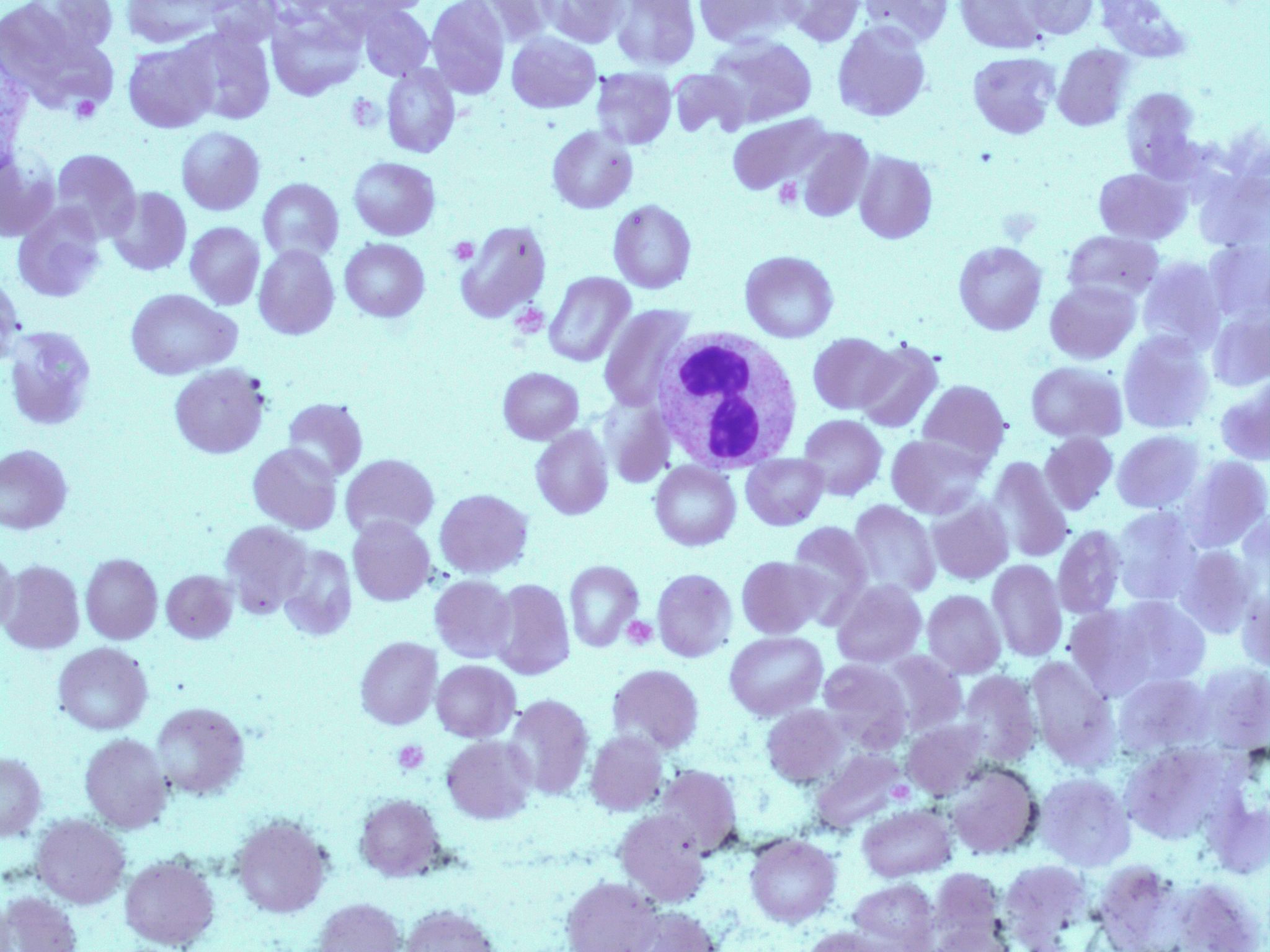 Pelger Huet Anomaly