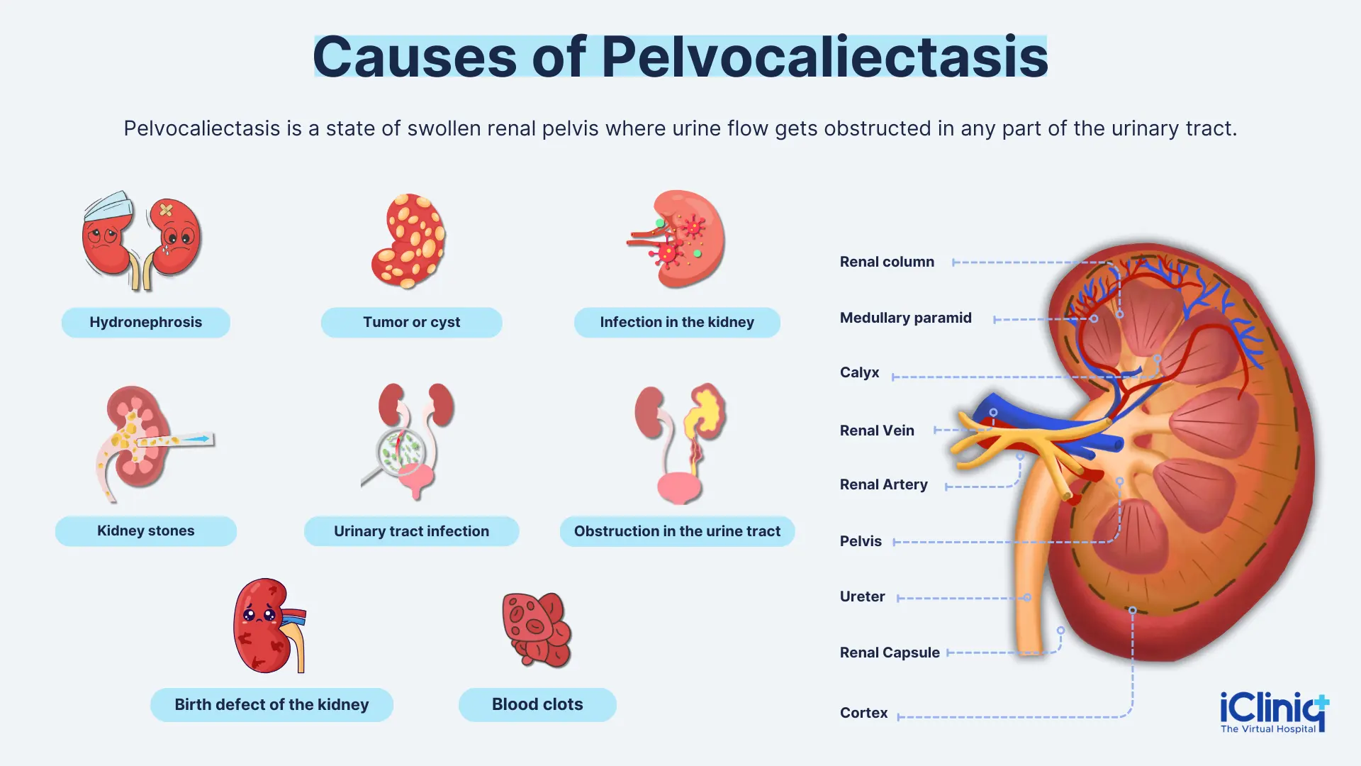 Pelviectasis Of Kidney