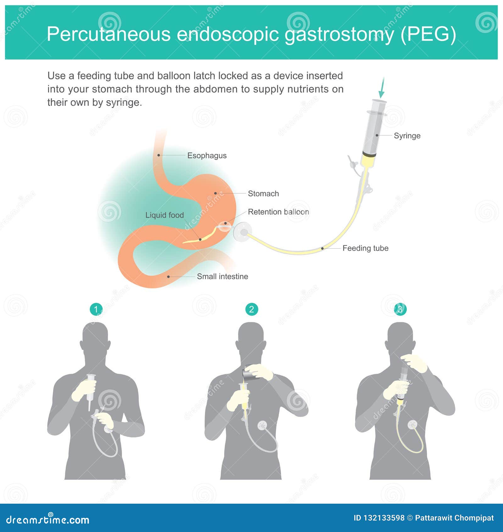 Percutaneous Endoscopic Gastrostomy