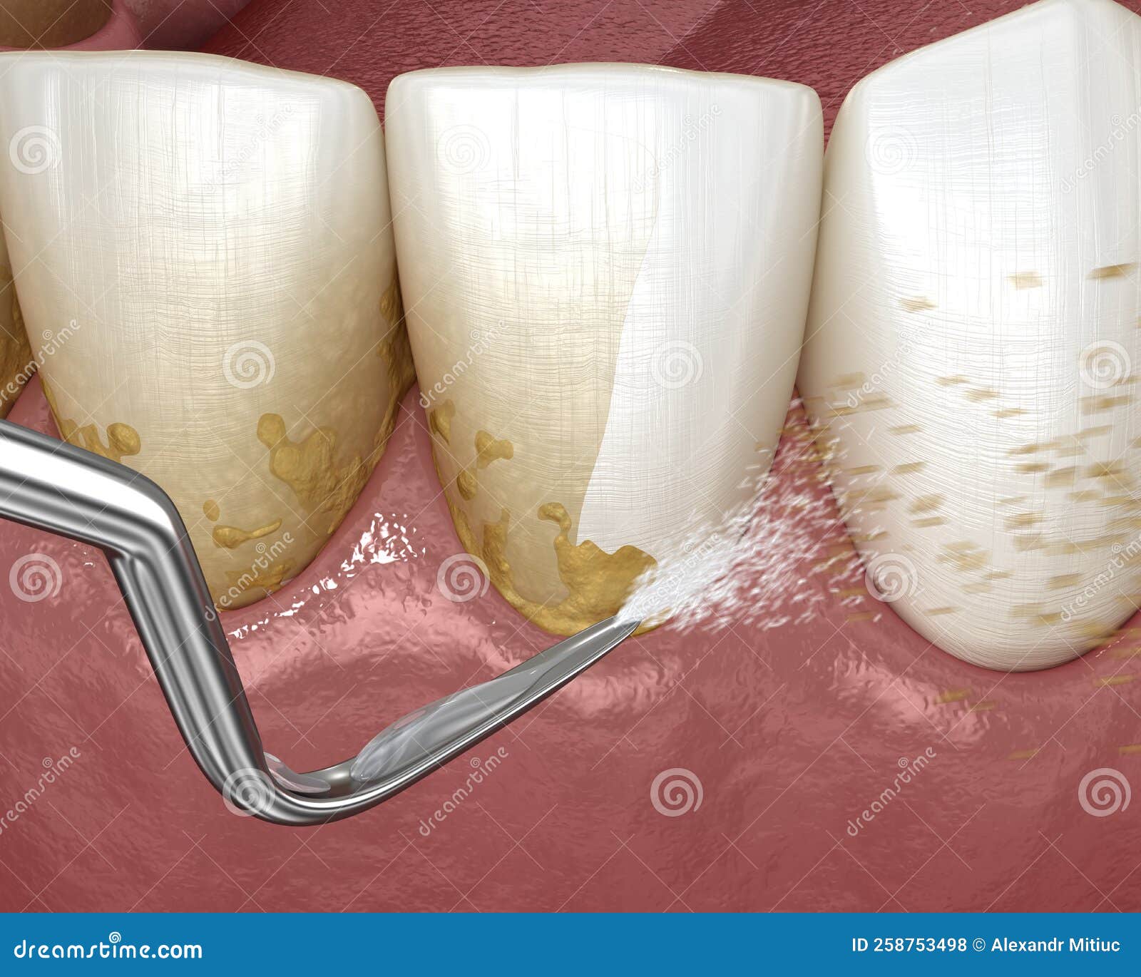 Periodontal Scaling And Root Planing