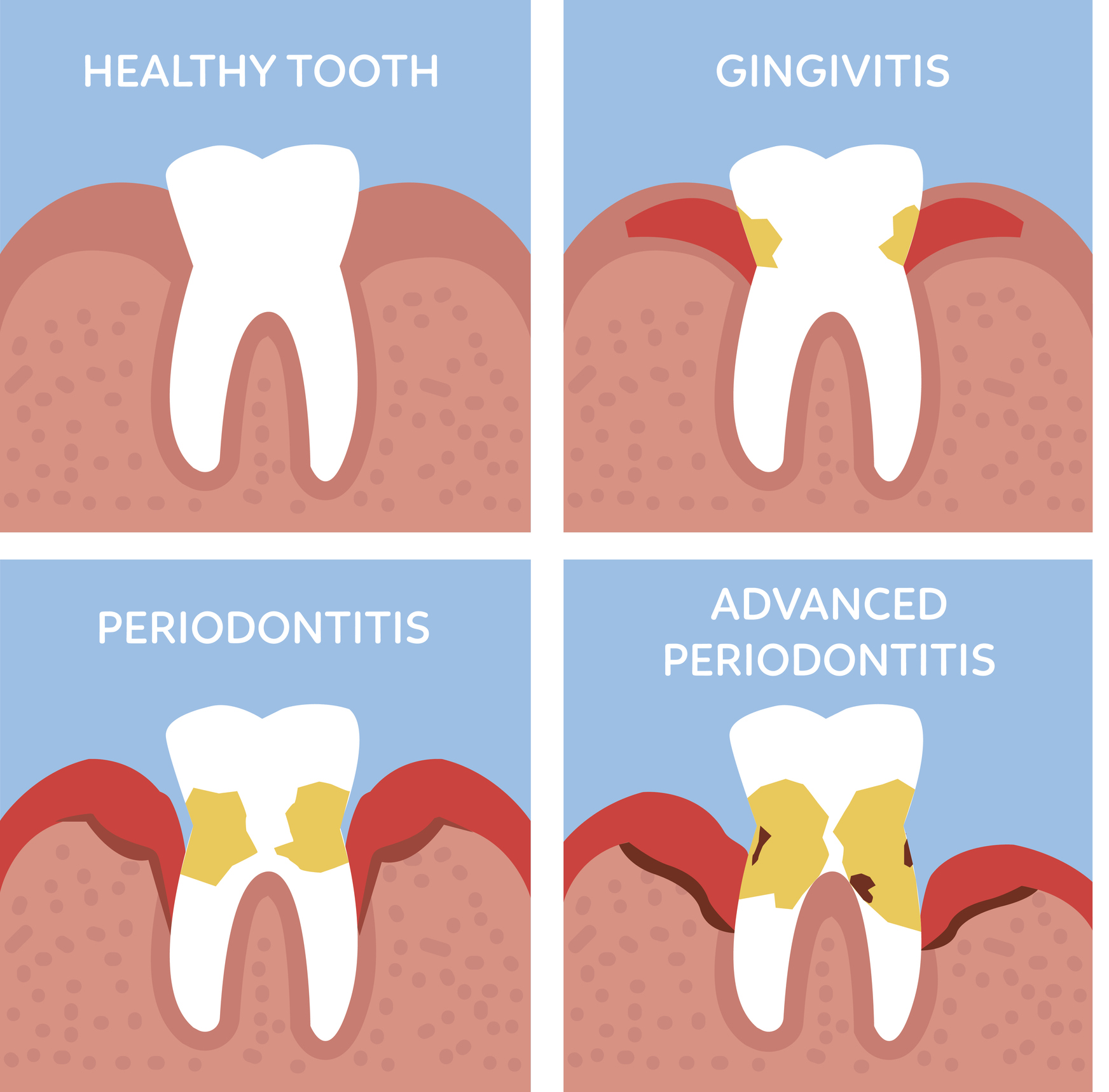 Periodontitis Vs Gingivitis
