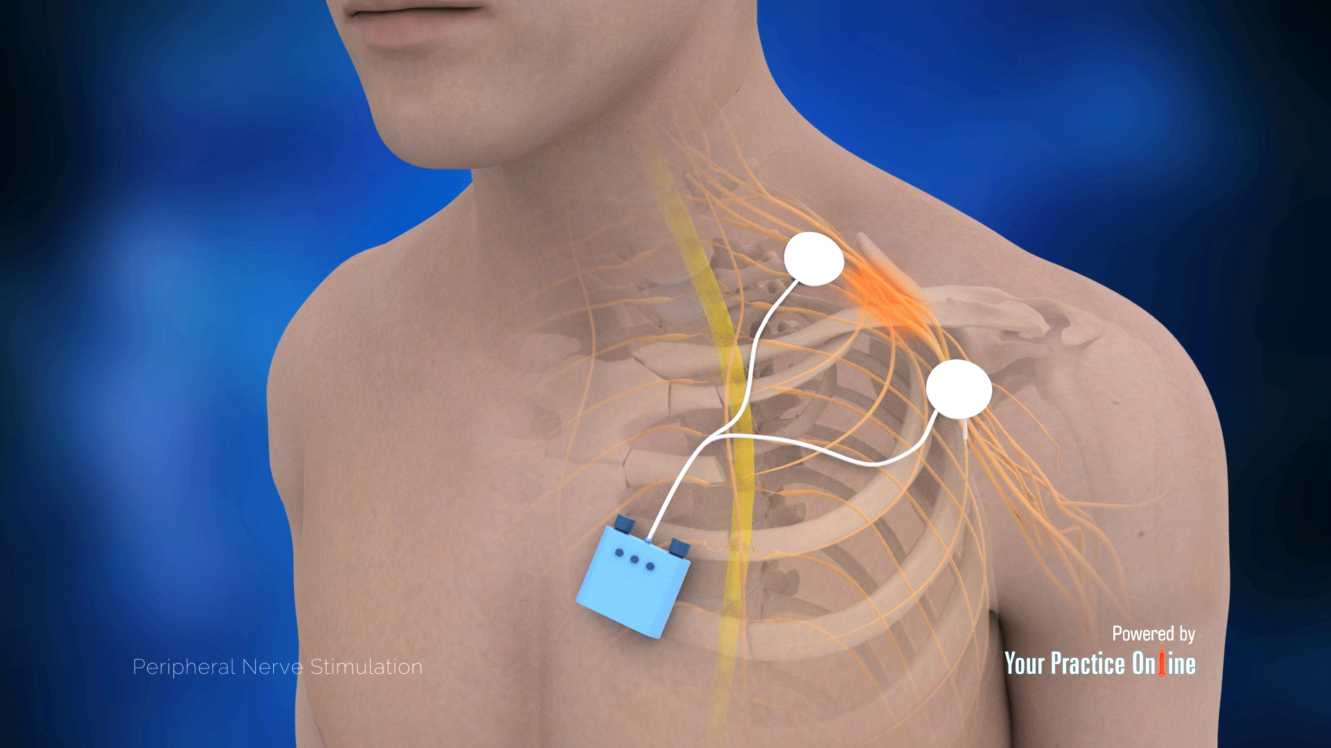 Peripheral Nerve Stimulator