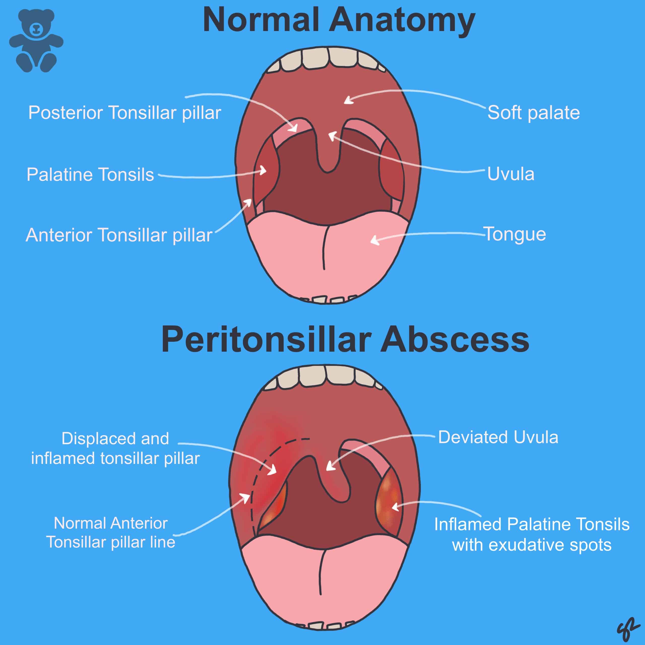 Peritonsillar Abscess Picture