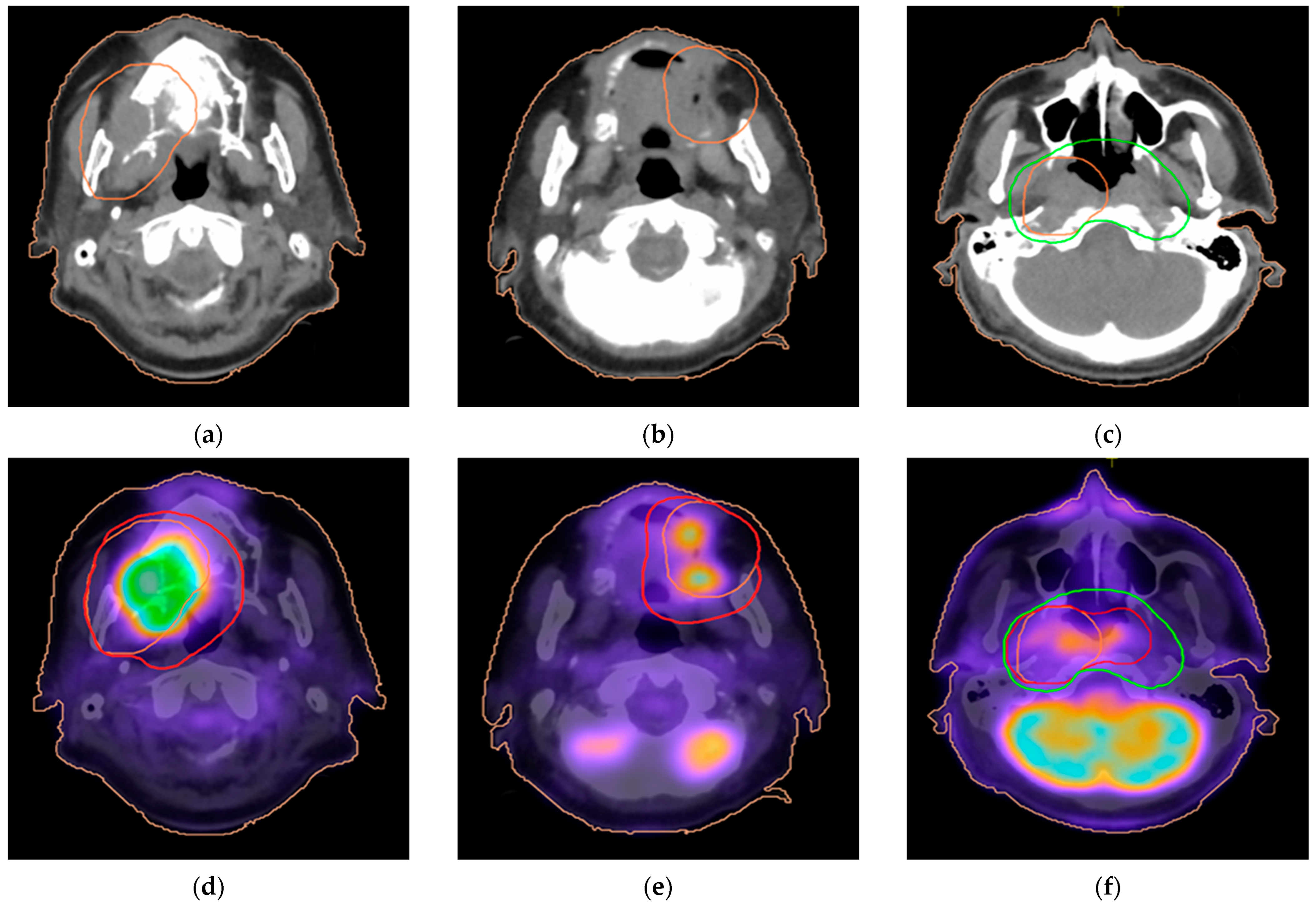 Pet Ct Vs Ct