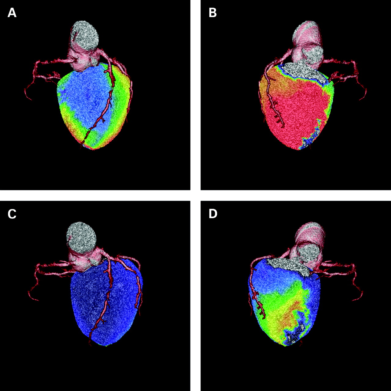 Pet Scan Heart