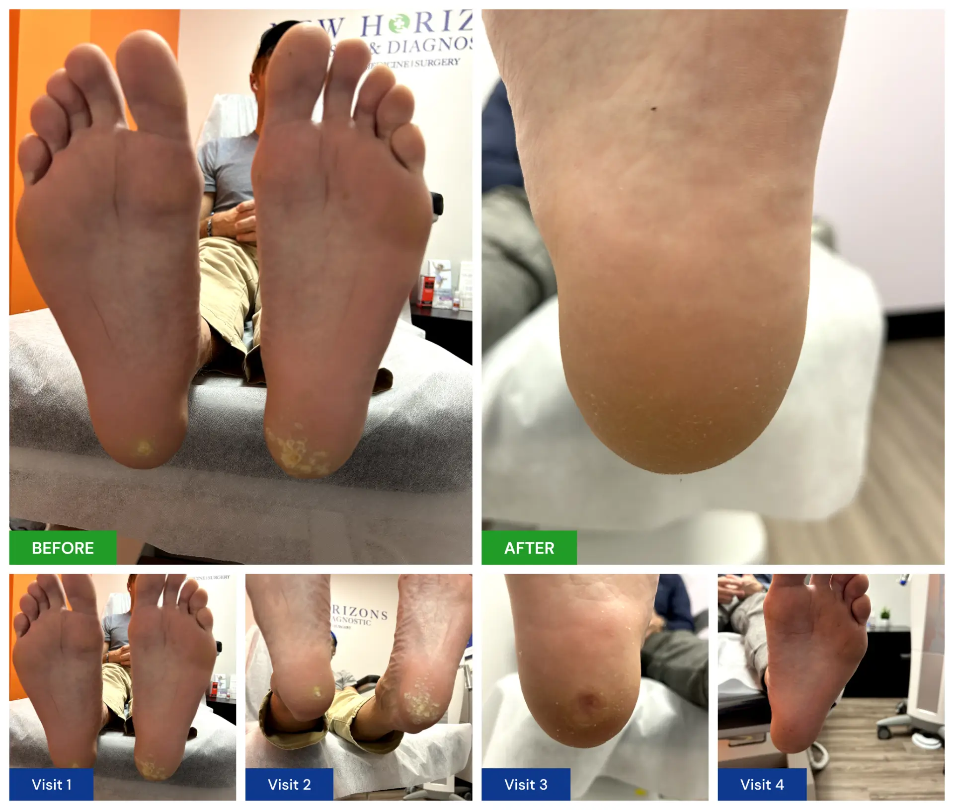 Phases Of Wart Removal Healing Time Pictures
