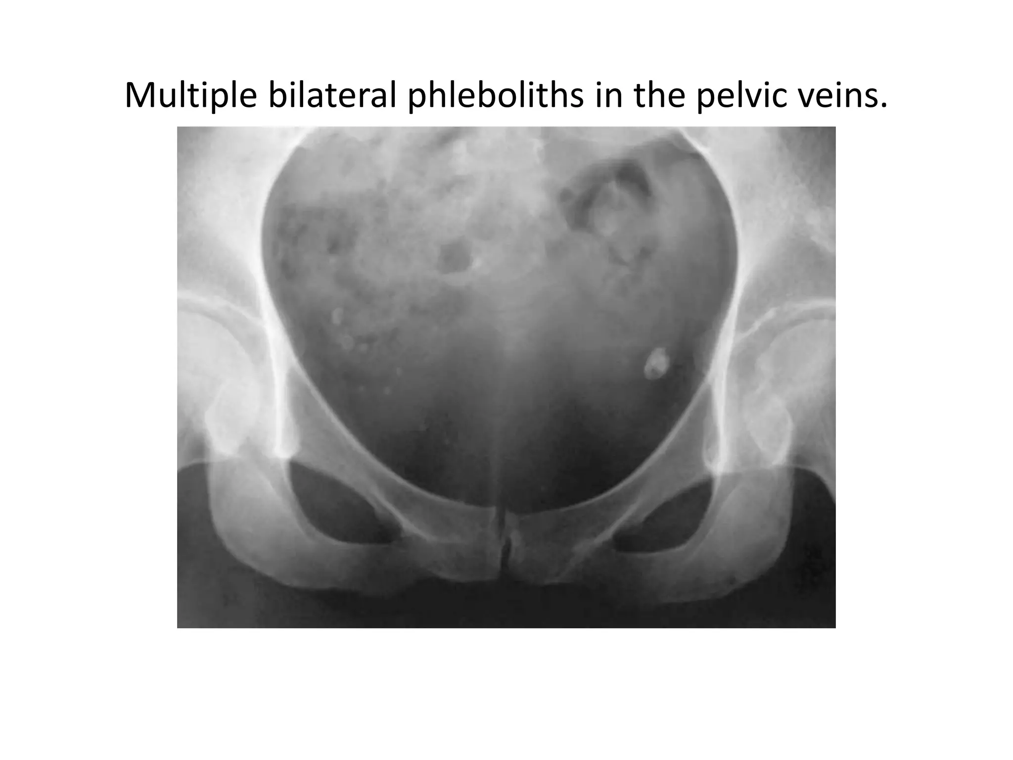 Phleboliths In Pelvis