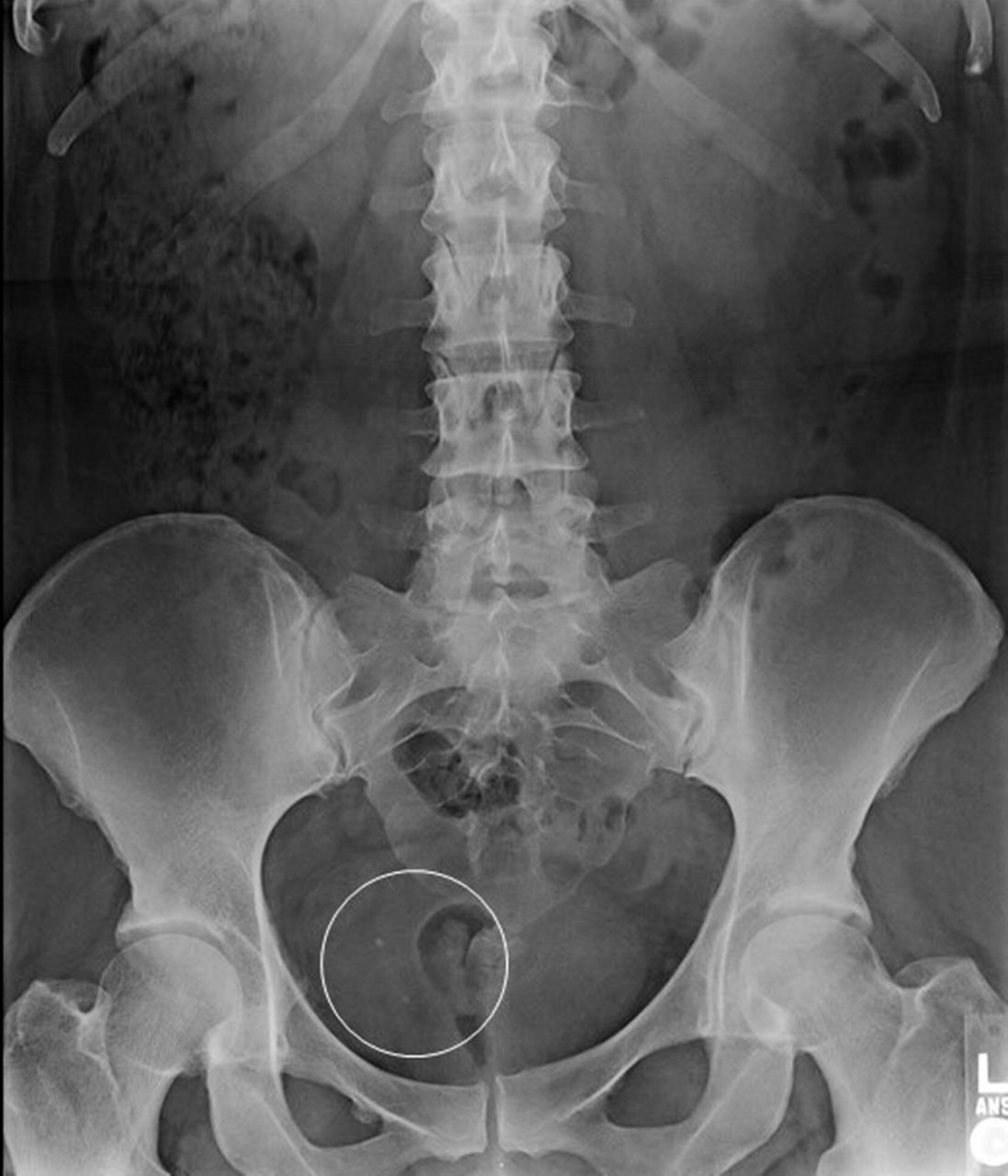 Phleboliths In The Pelvis