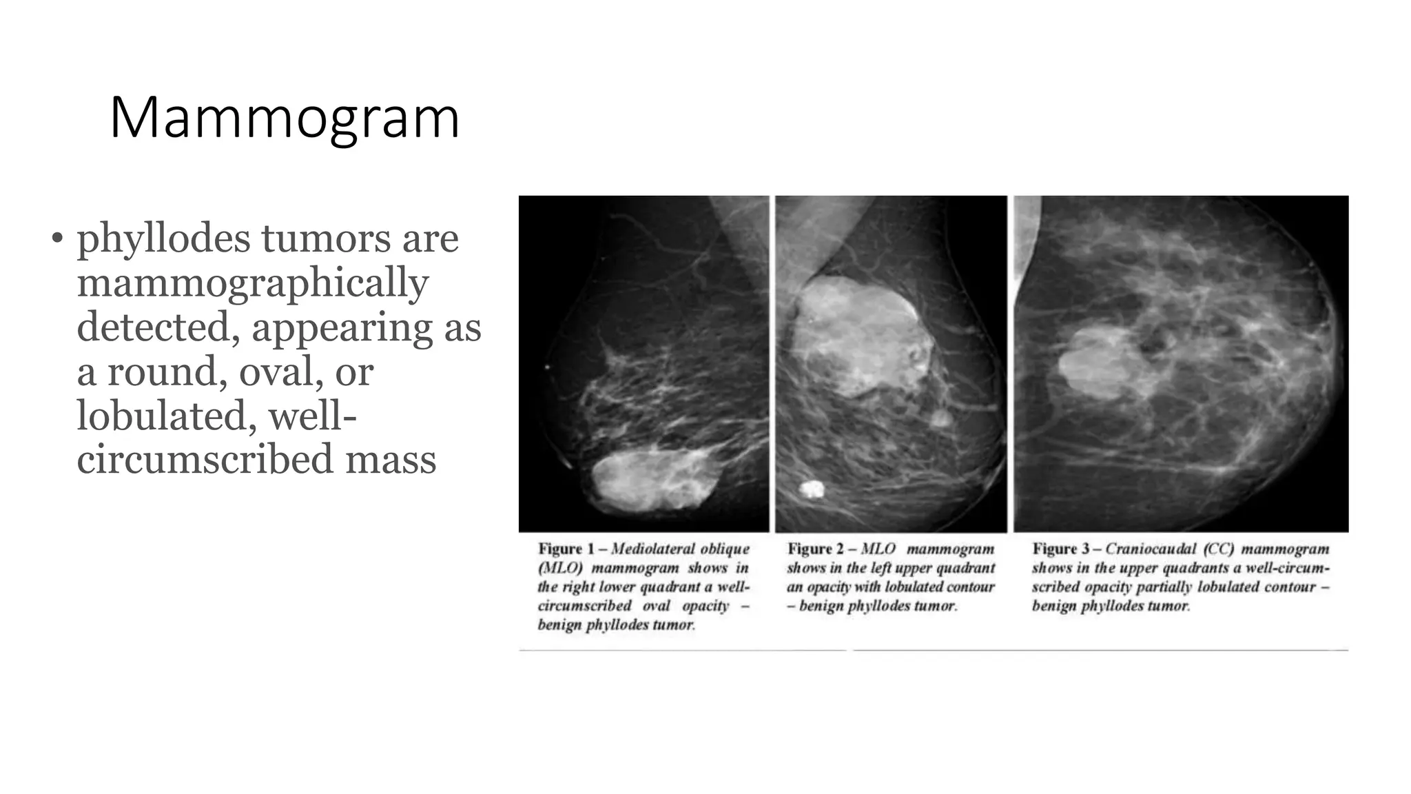 Phyllodes Tumor Breast