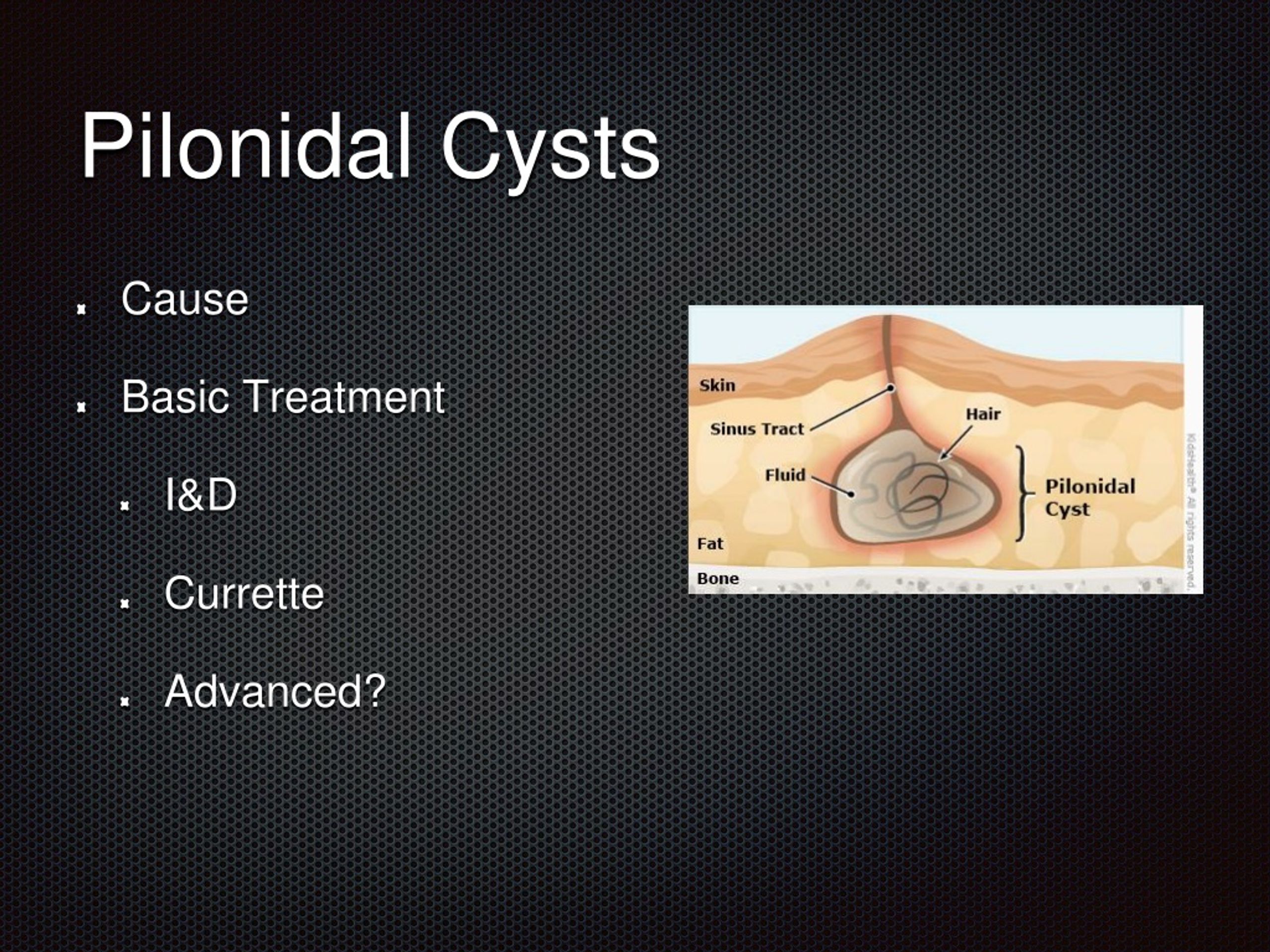 Pilonidal Cyst Drainage Surgery