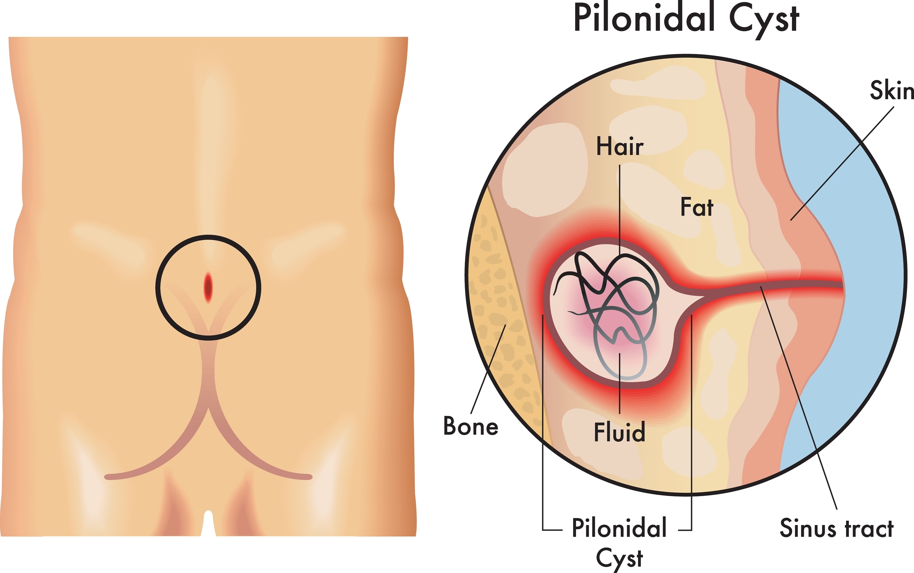 Pilonidal Sinus Popped