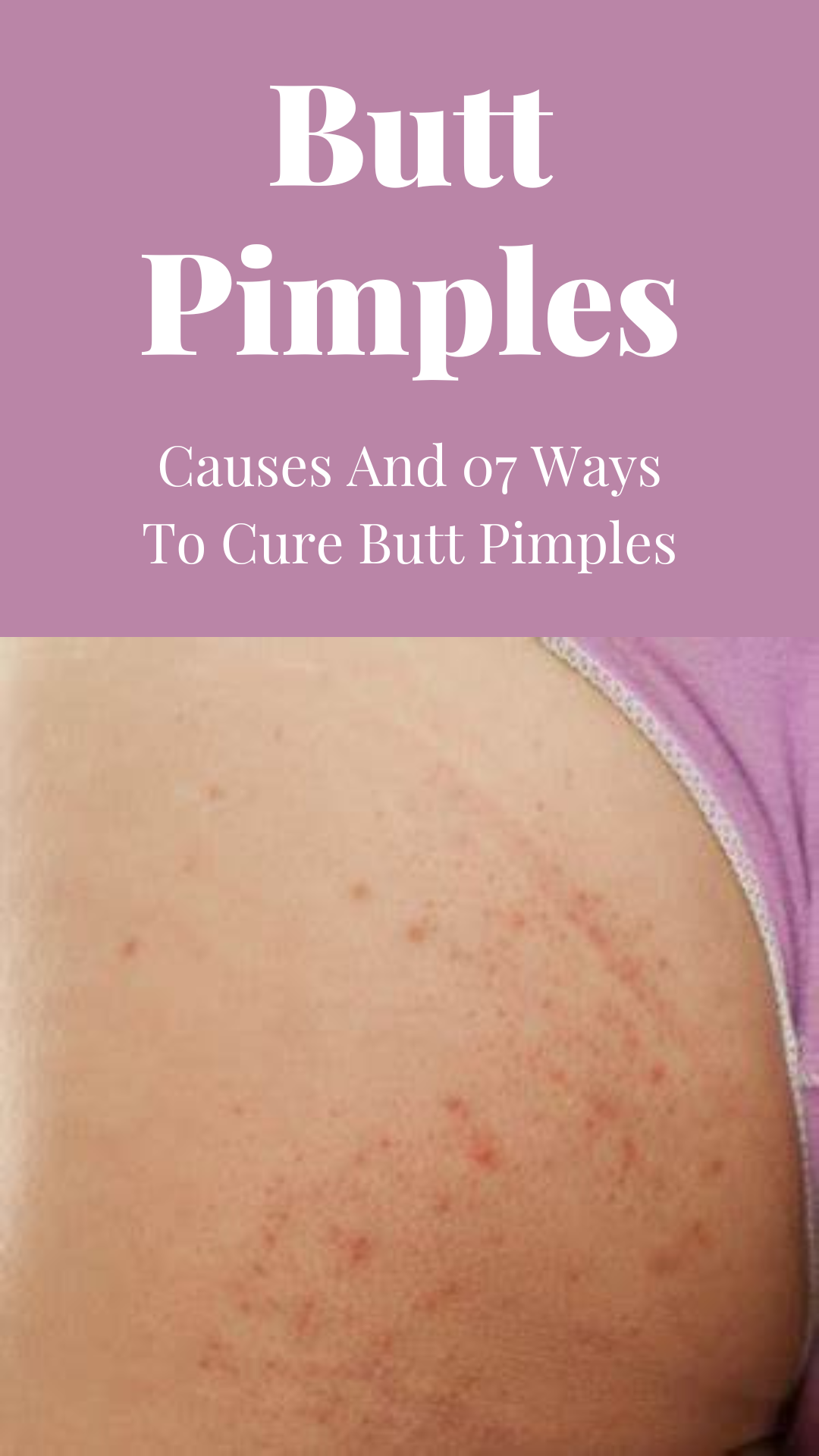 Pimple On Butt