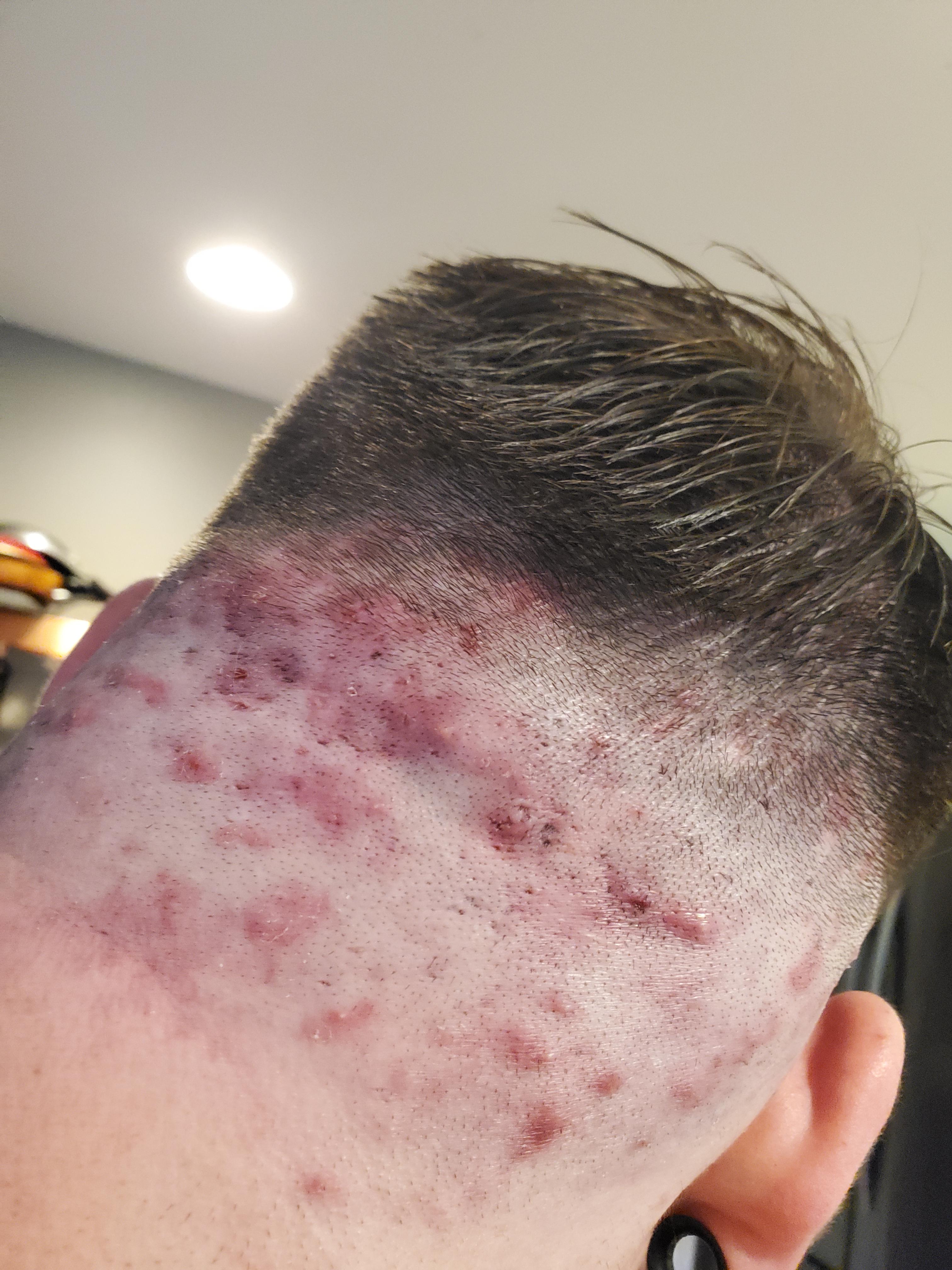 Pimples On Head