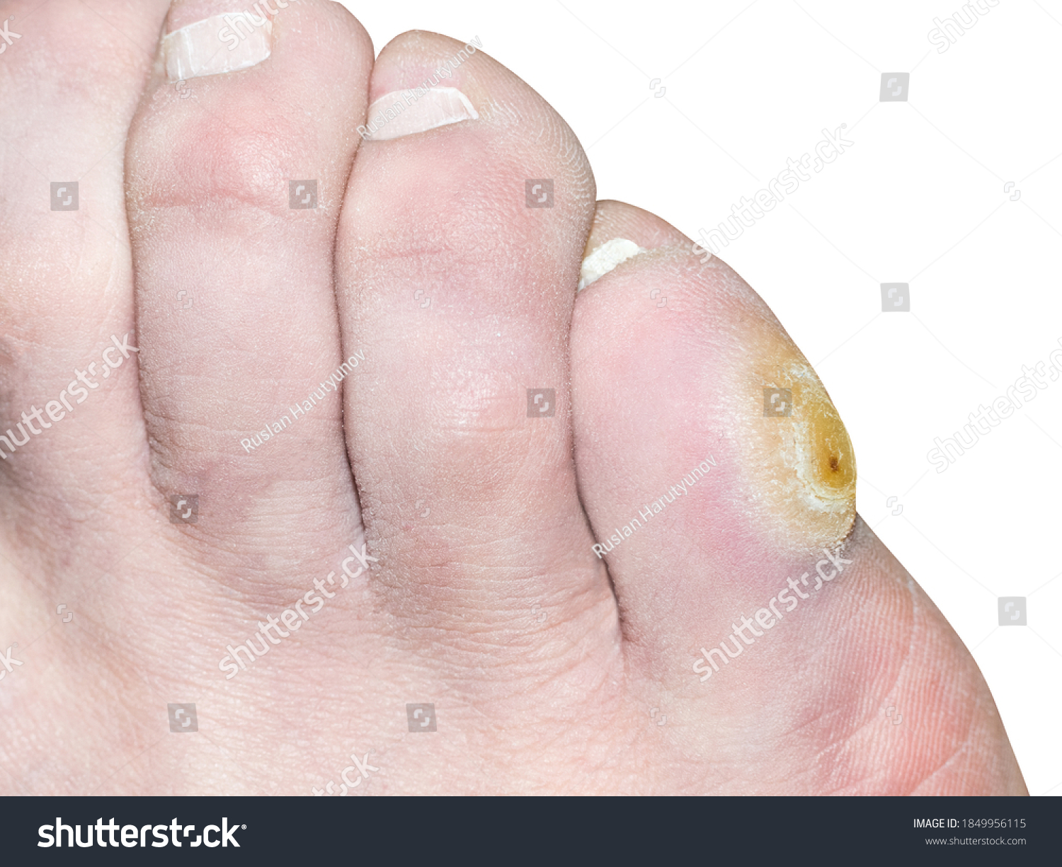 Pinky Toe Corn Callus