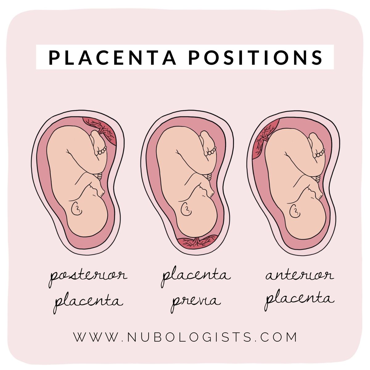 Placenta Is Posterior Meaning