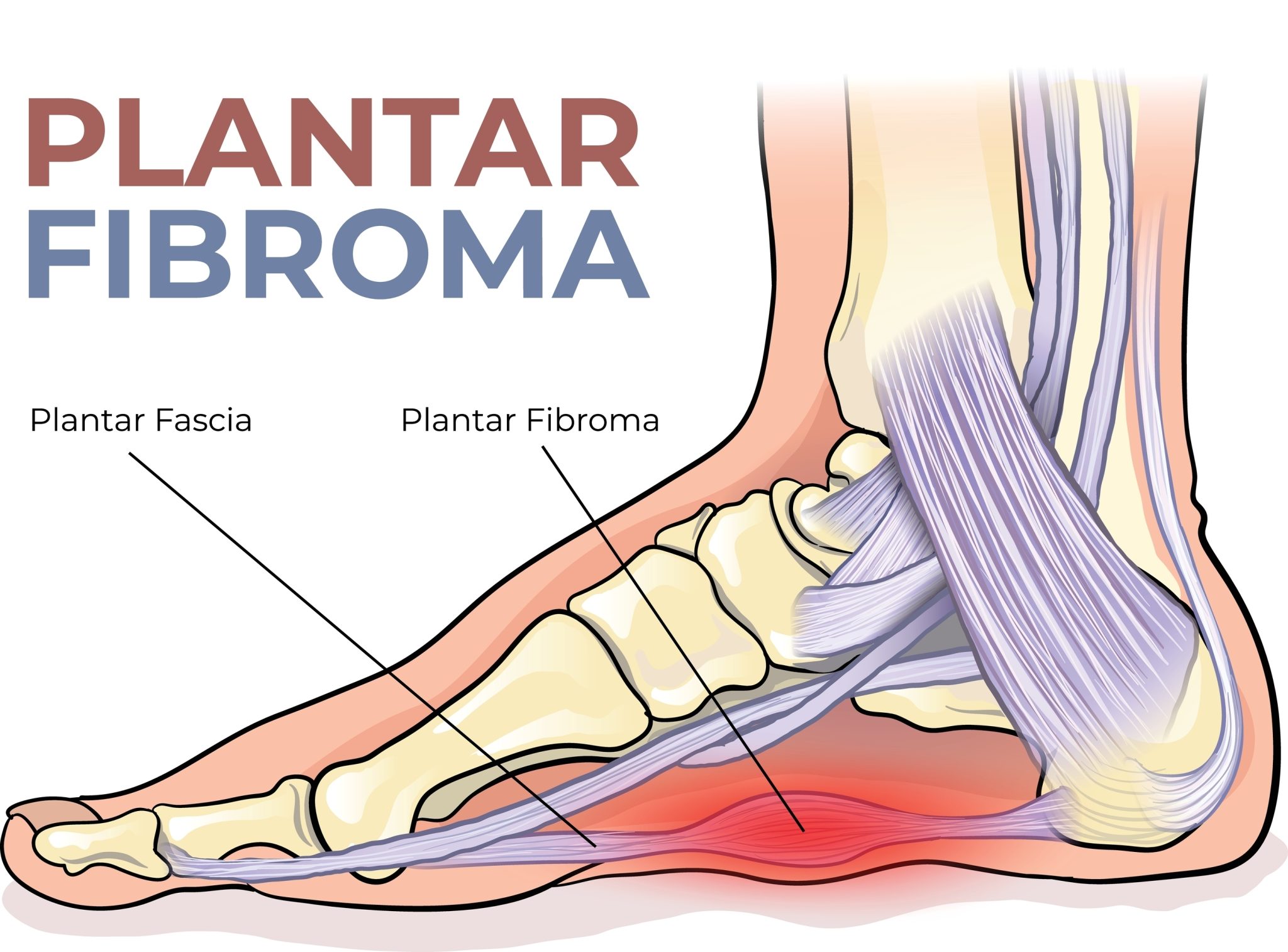 Plantar Fascia Fibromatosis