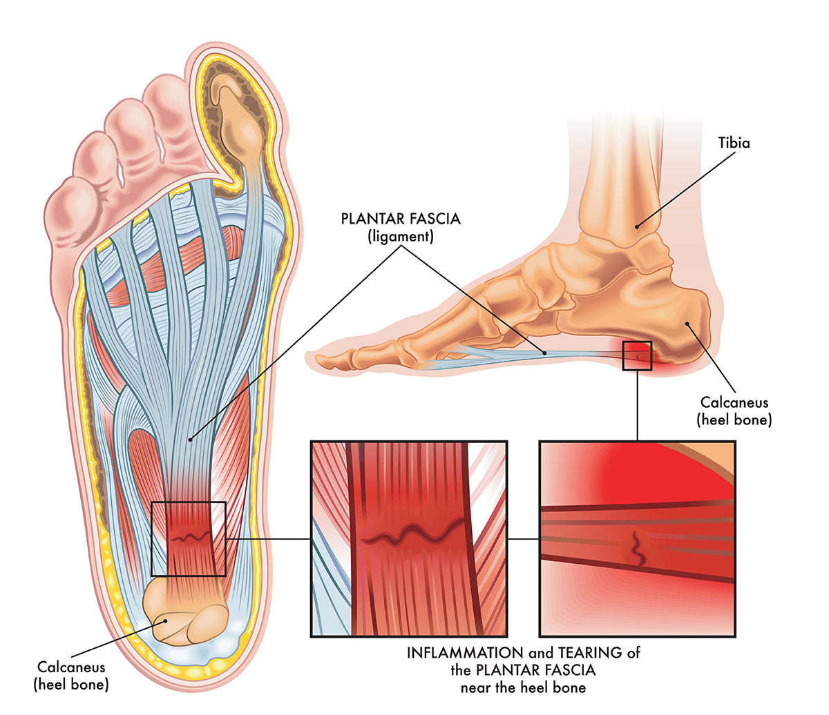 Plantar Fascia Tear