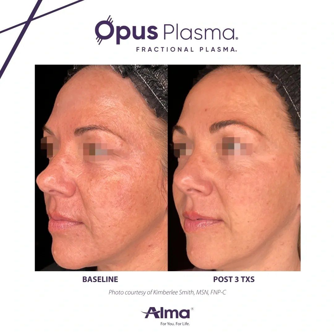 Plasma Rich Facial