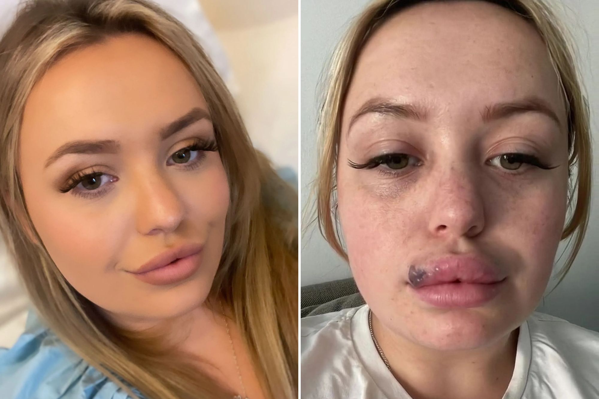 Plastic Surgery Duck Face