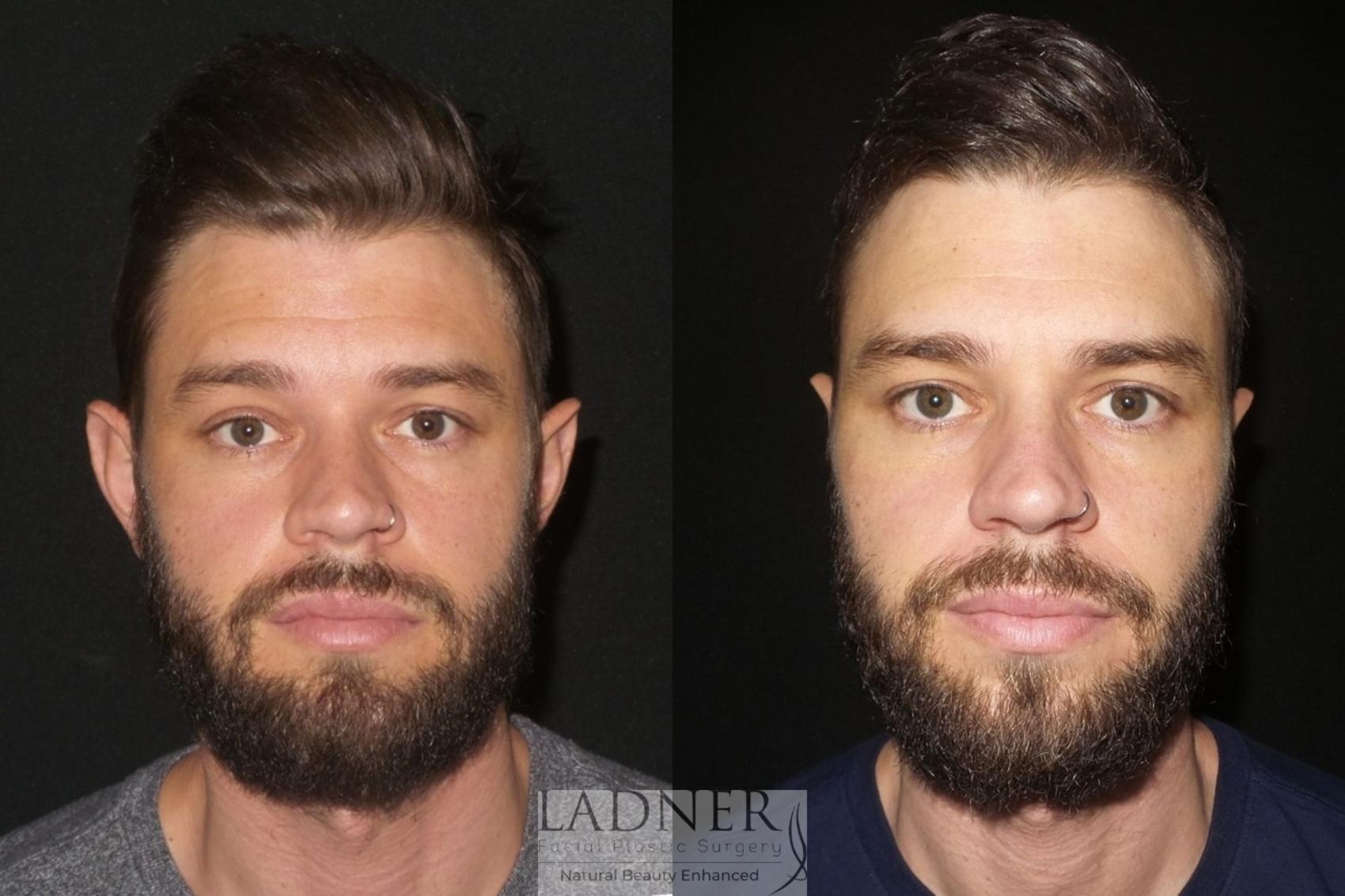 Plastic Surgery For Men Face