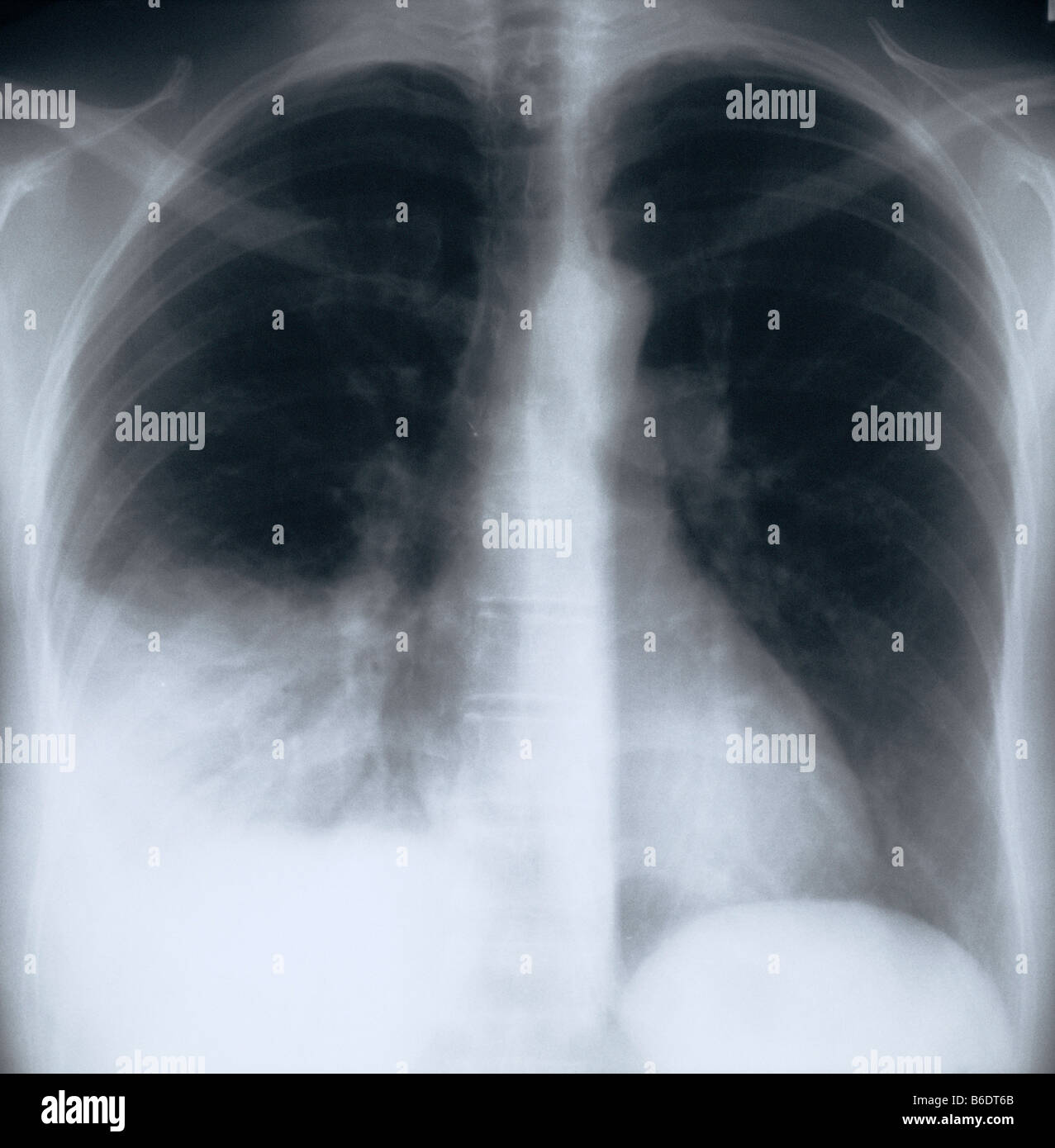 Pneumonia Chest X Ray