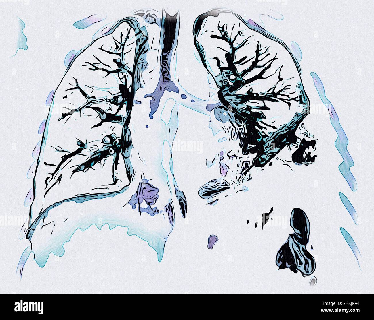 Pneumonia Ct Scan