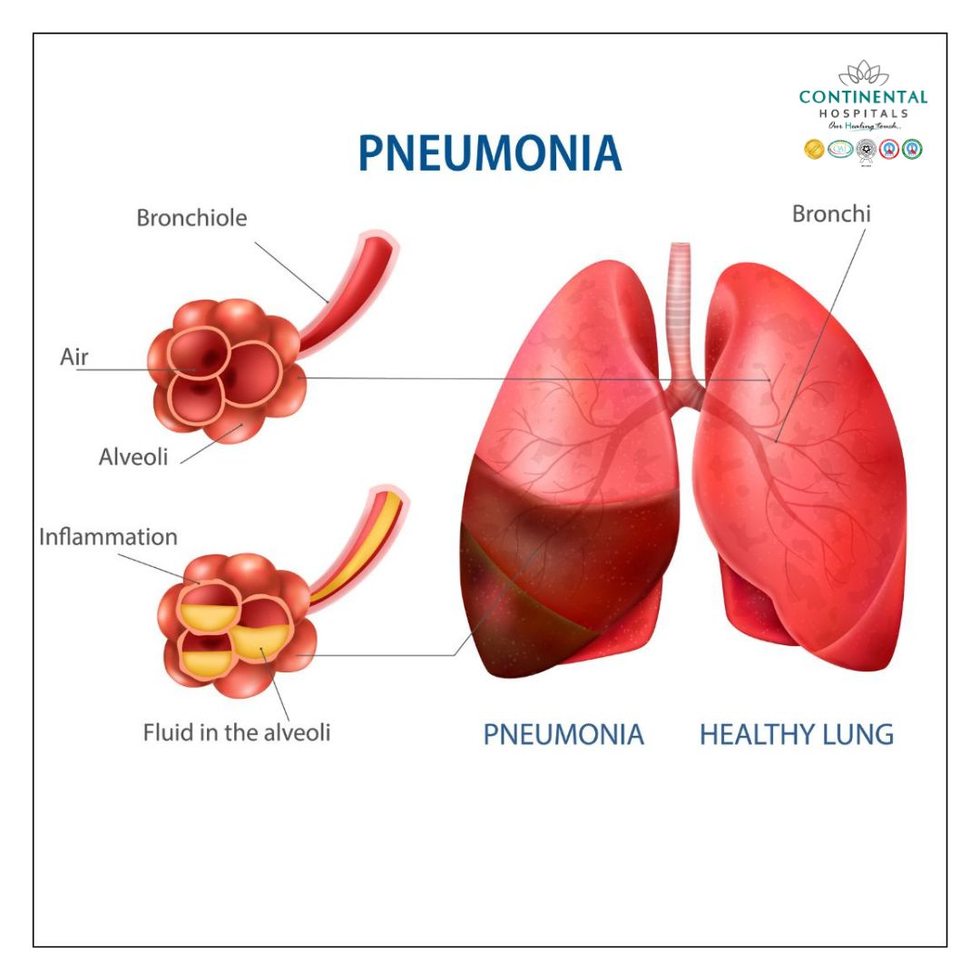 Pneumonia Is It Contagious