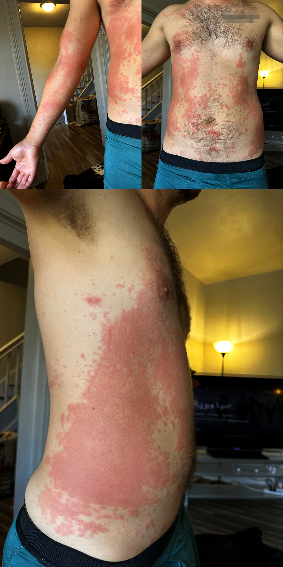 Poision Ivy Rash