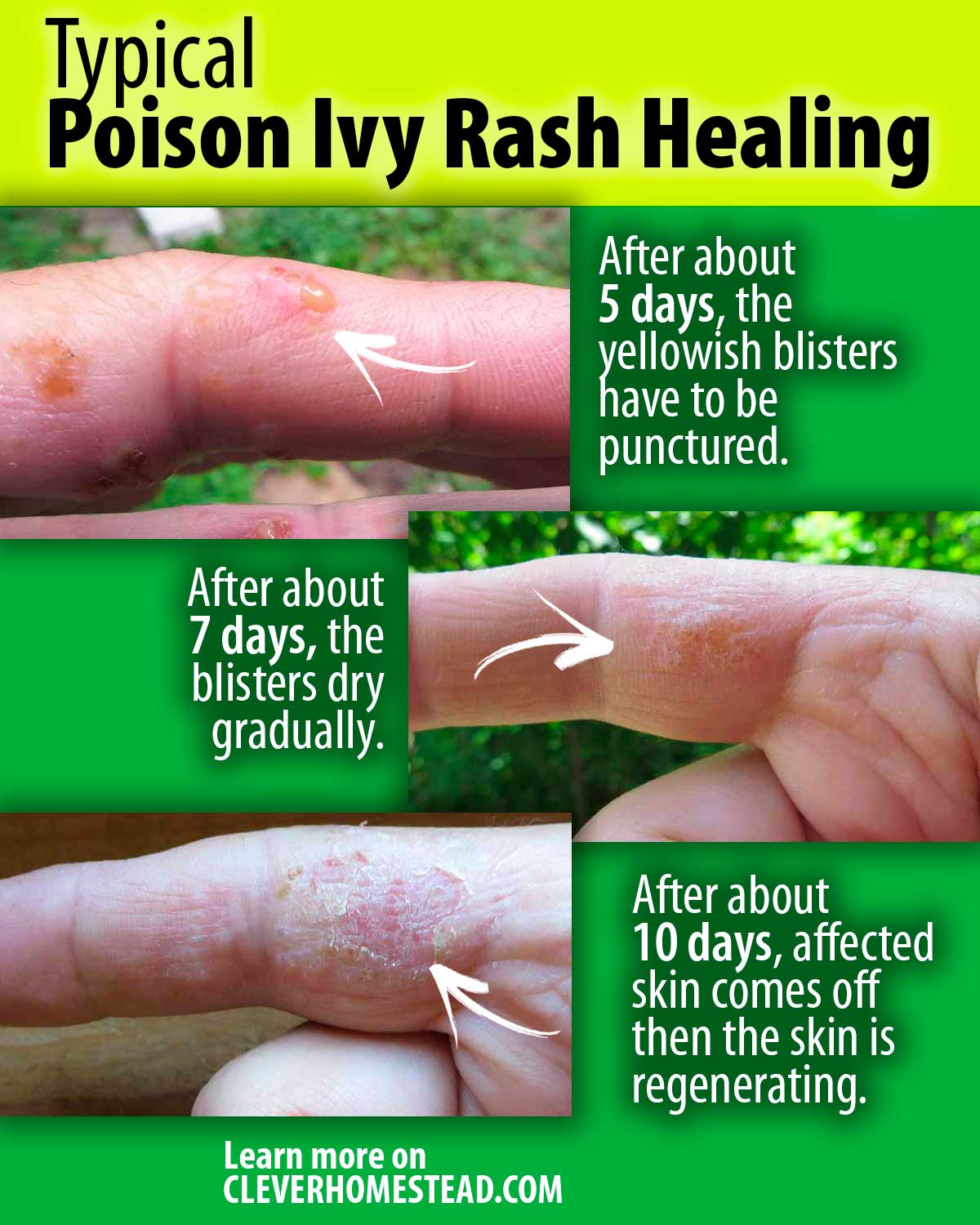 Poison Ivy Healing Stages