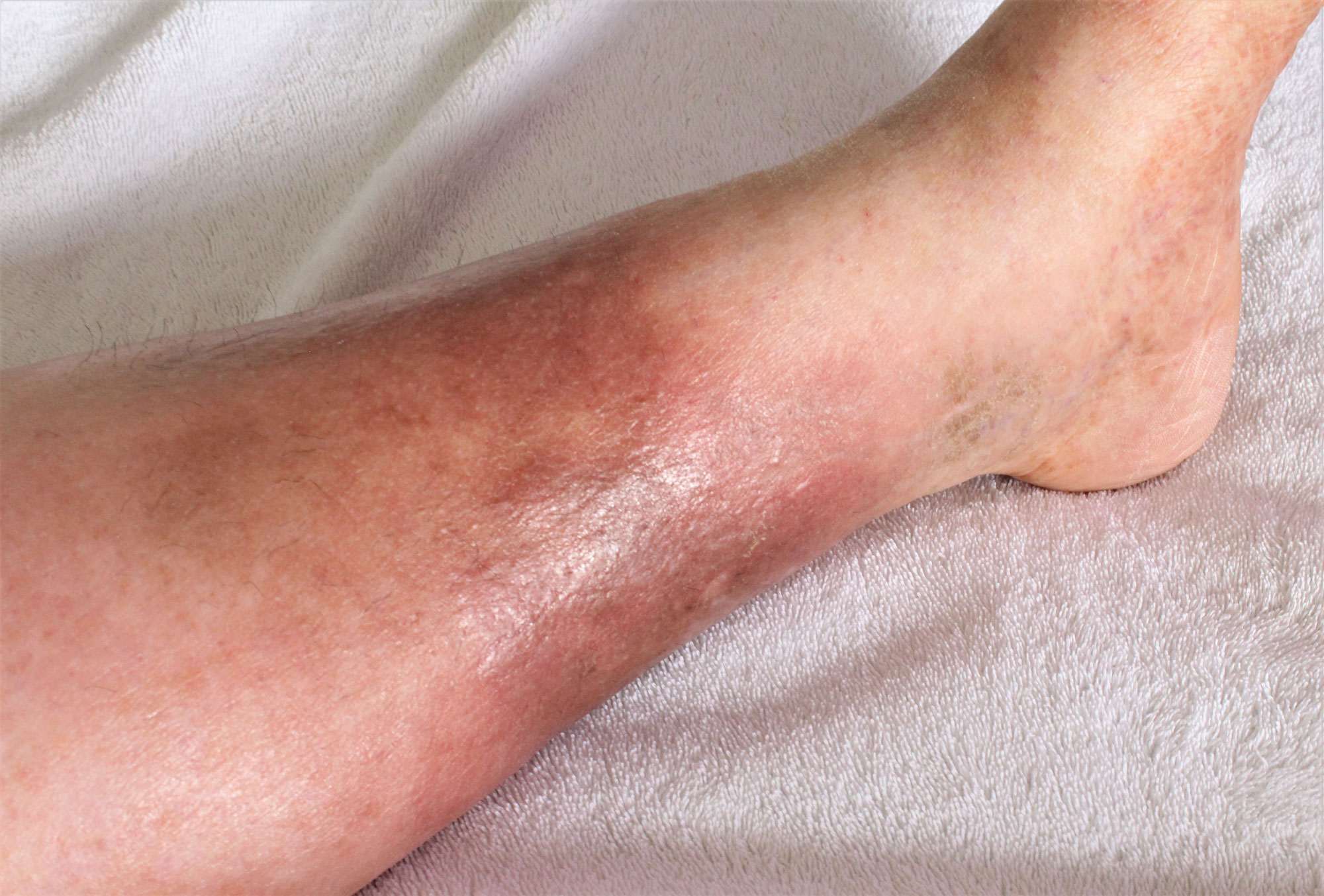 Popped Blood Vein