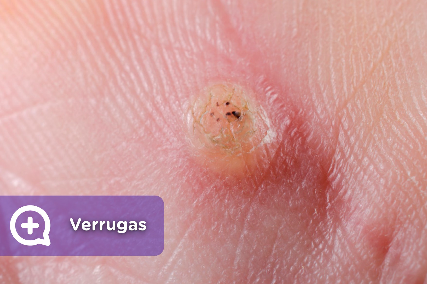 Porque Salen Las Verrugas