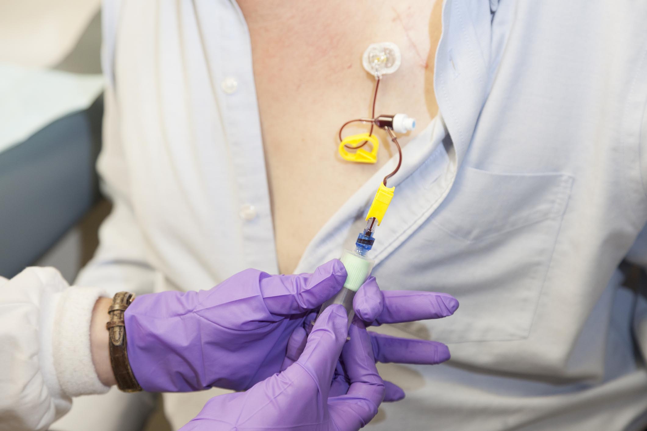 Port Placement For Chemo