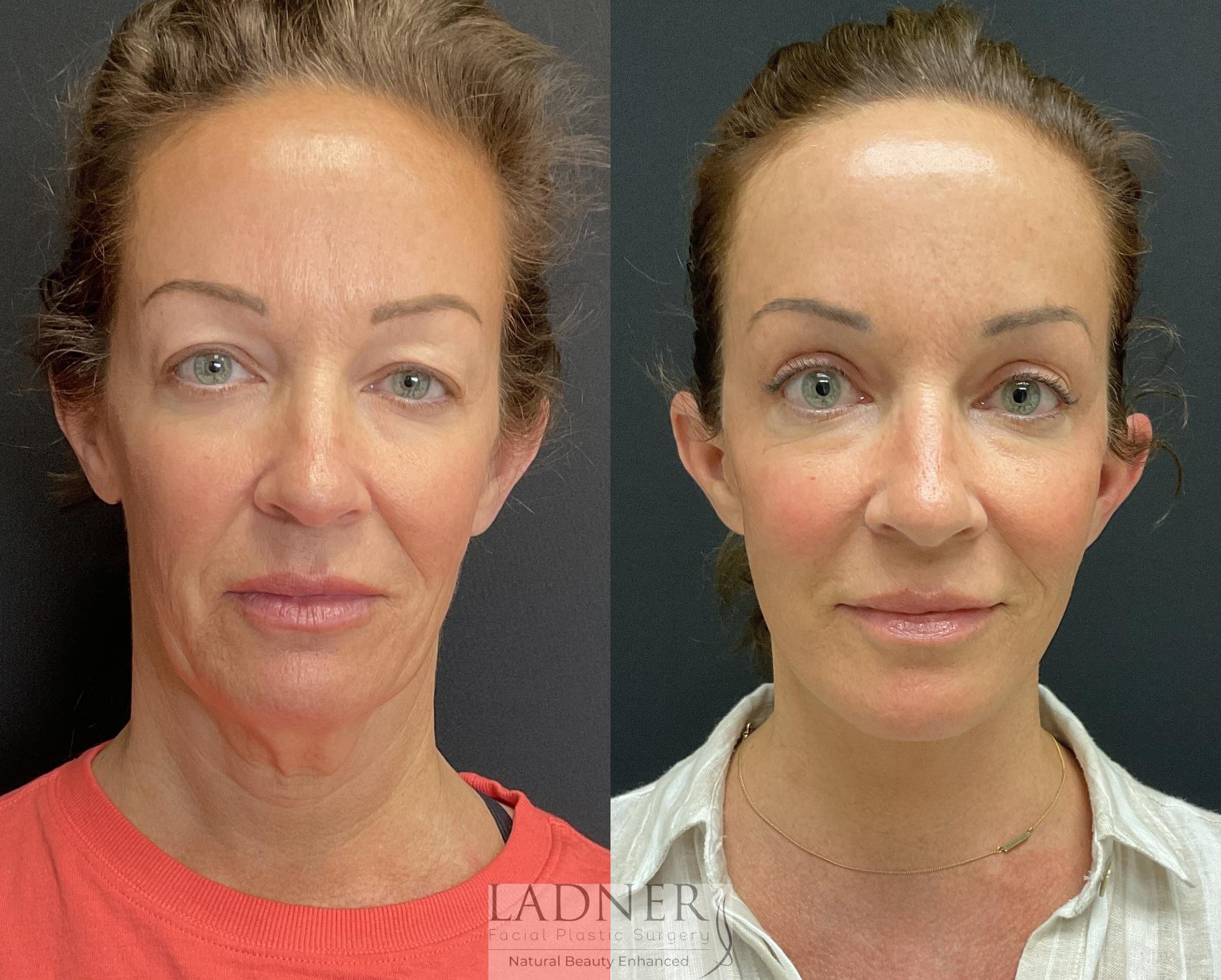 Post Plastic Surgery Face