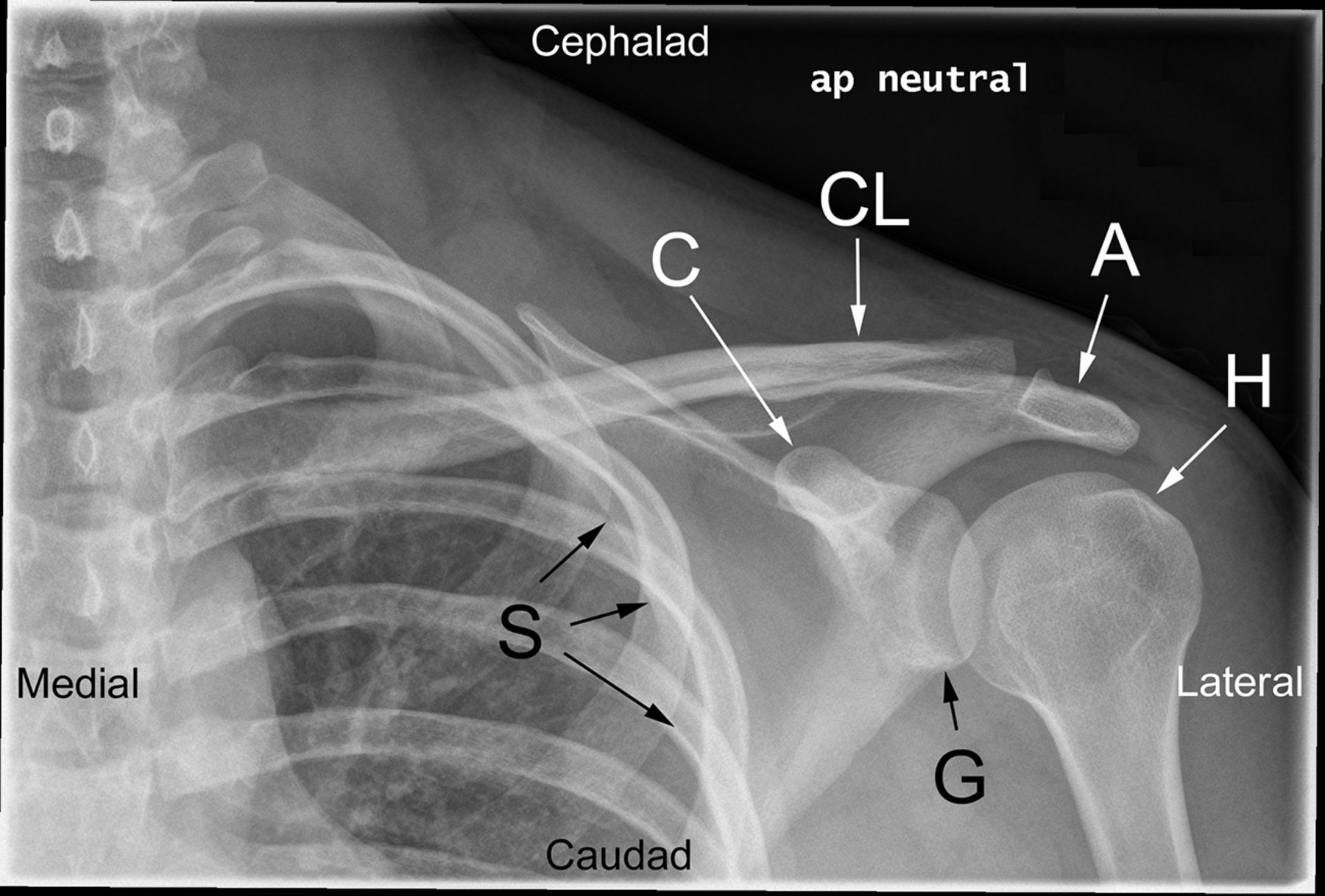 Posterior Shoulder Dislocation