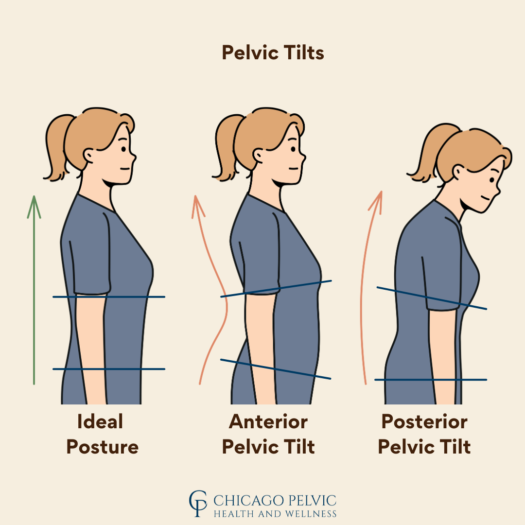 Posterior Tilt Pelvic