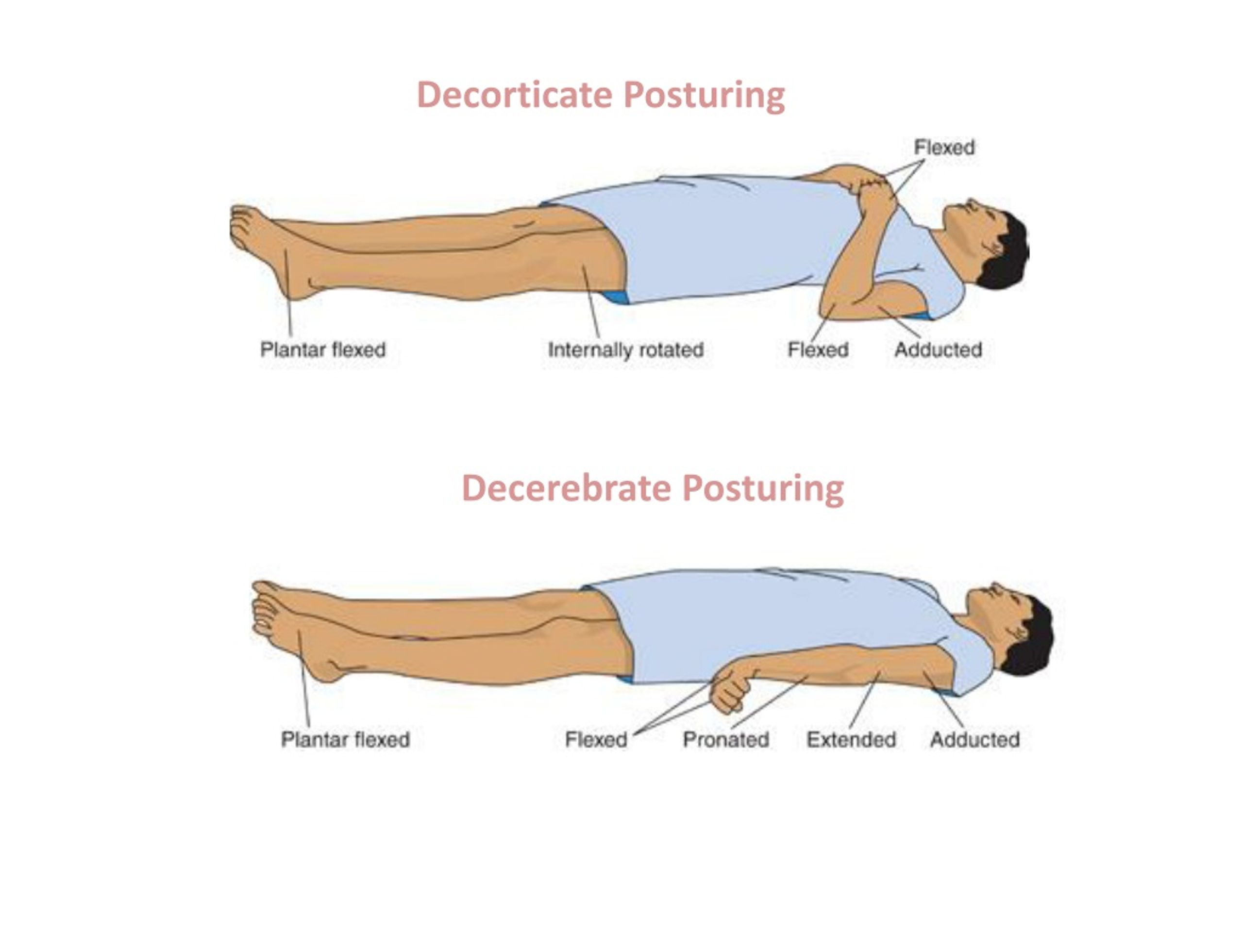 Posturing Decerebrate Vs Decorticate