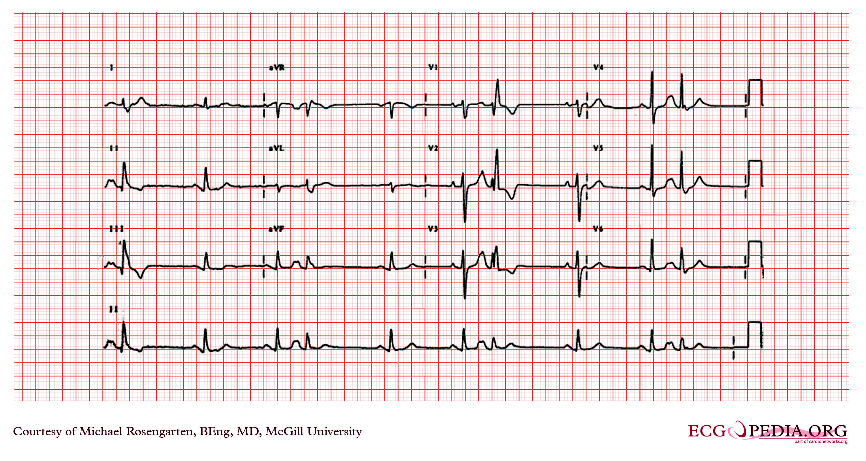 Premature Atrial Complexes