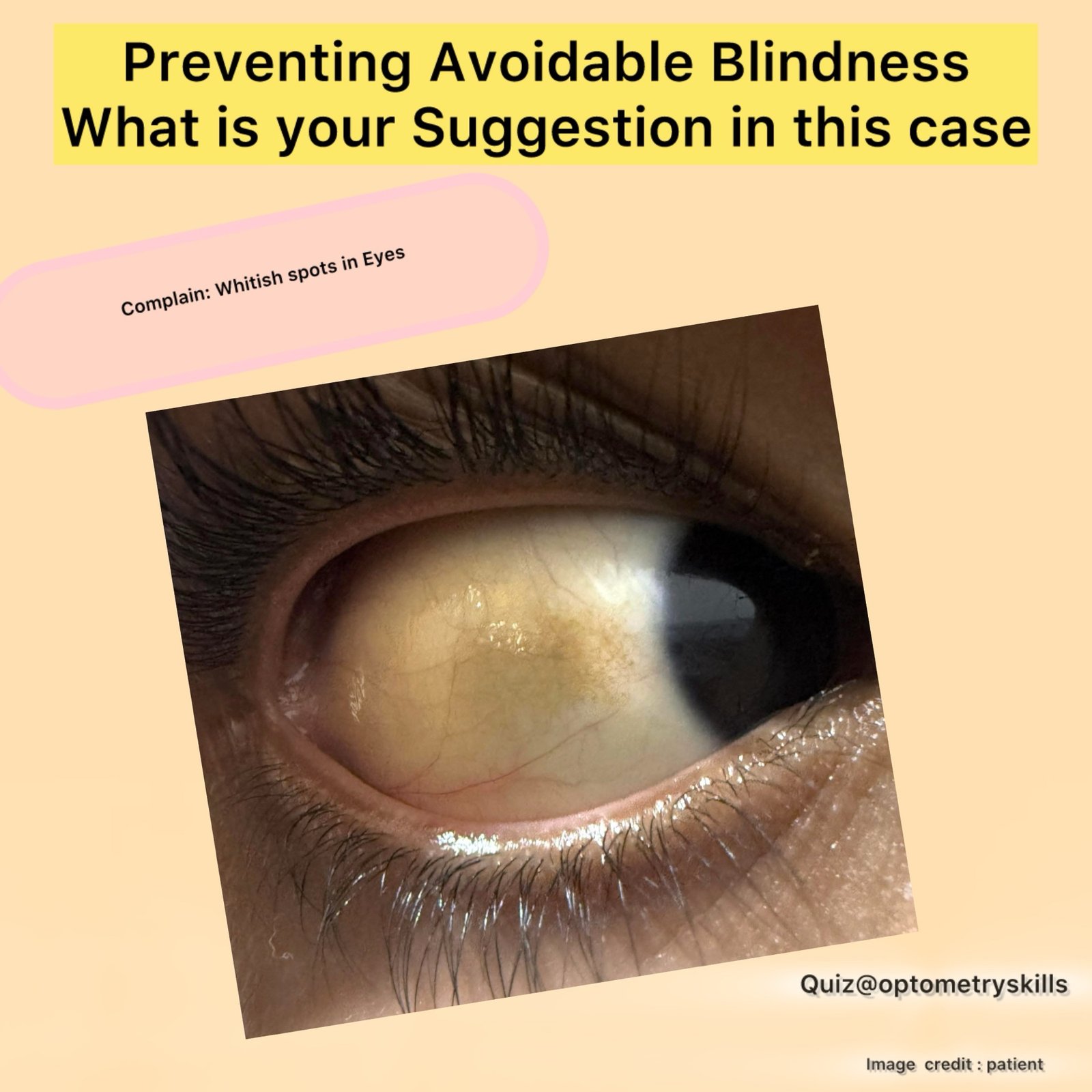 Pressure Behind Left Eye