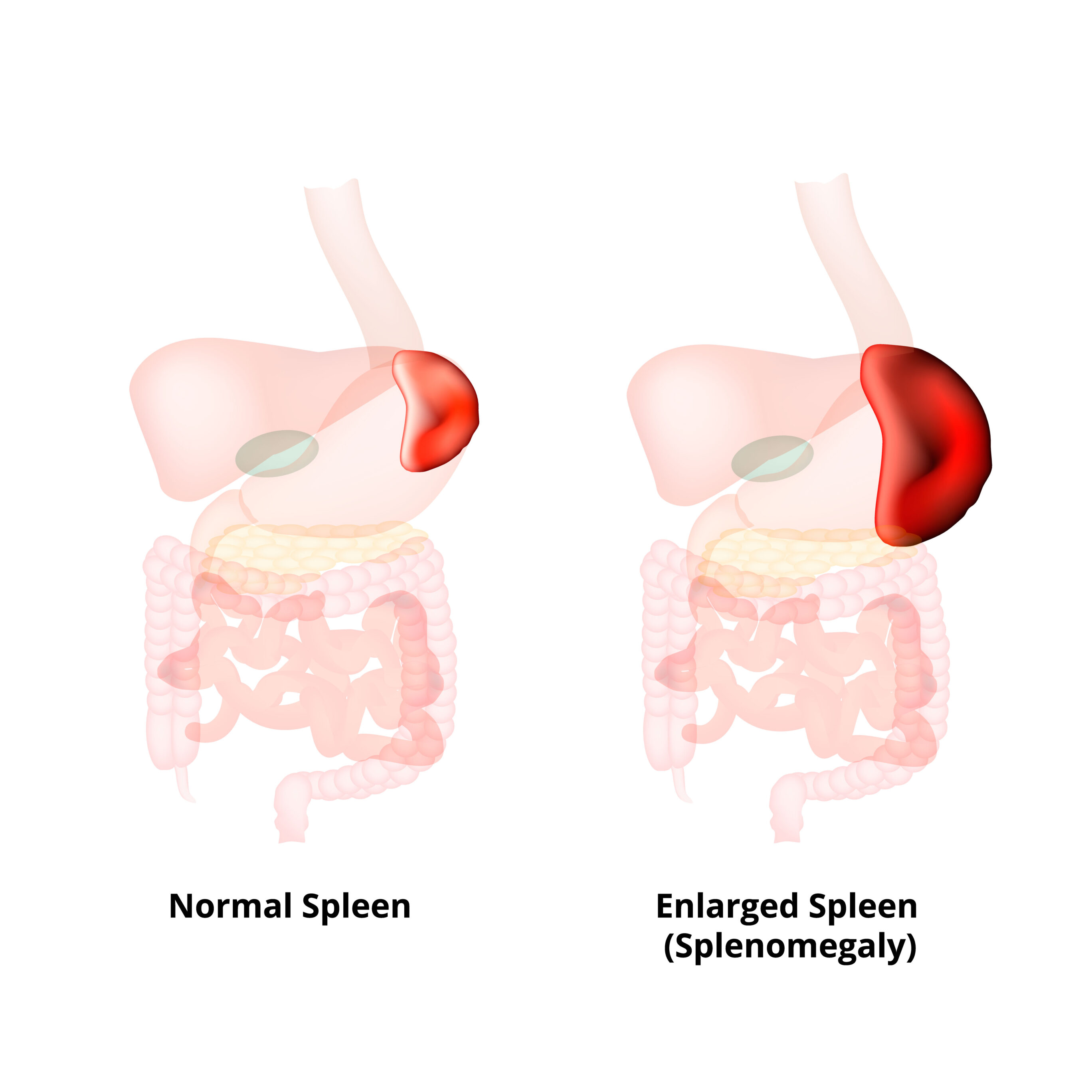 Problems With The Spleen