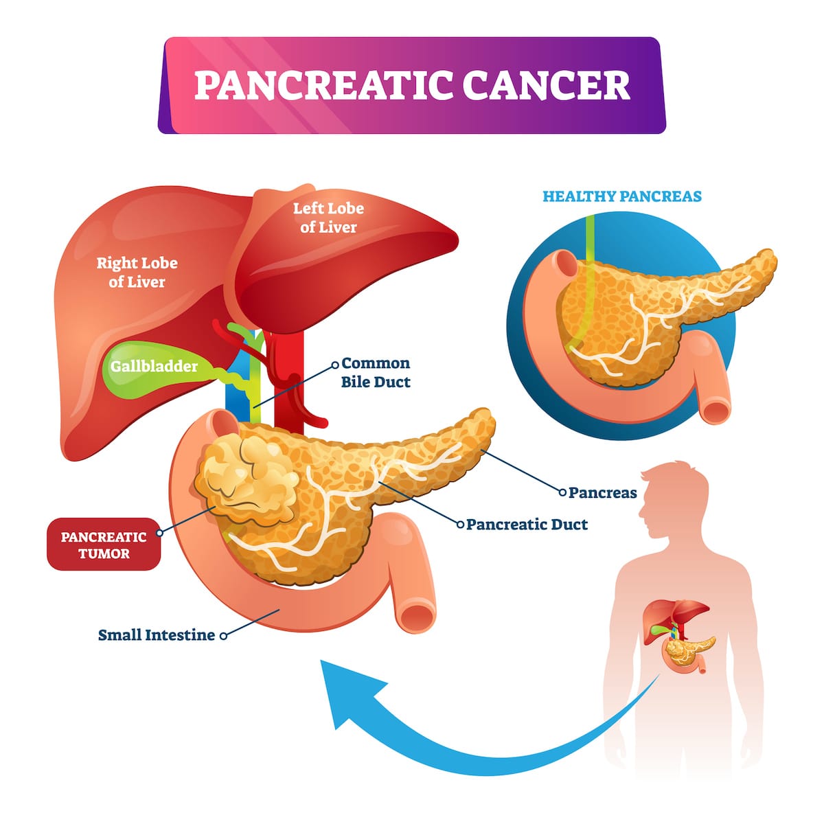 Problems With Your Pancreas