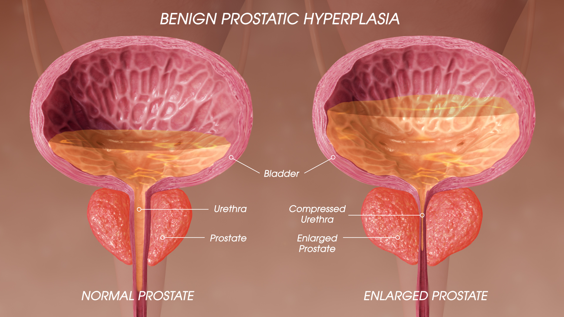 Procedure Enlarged Prostate