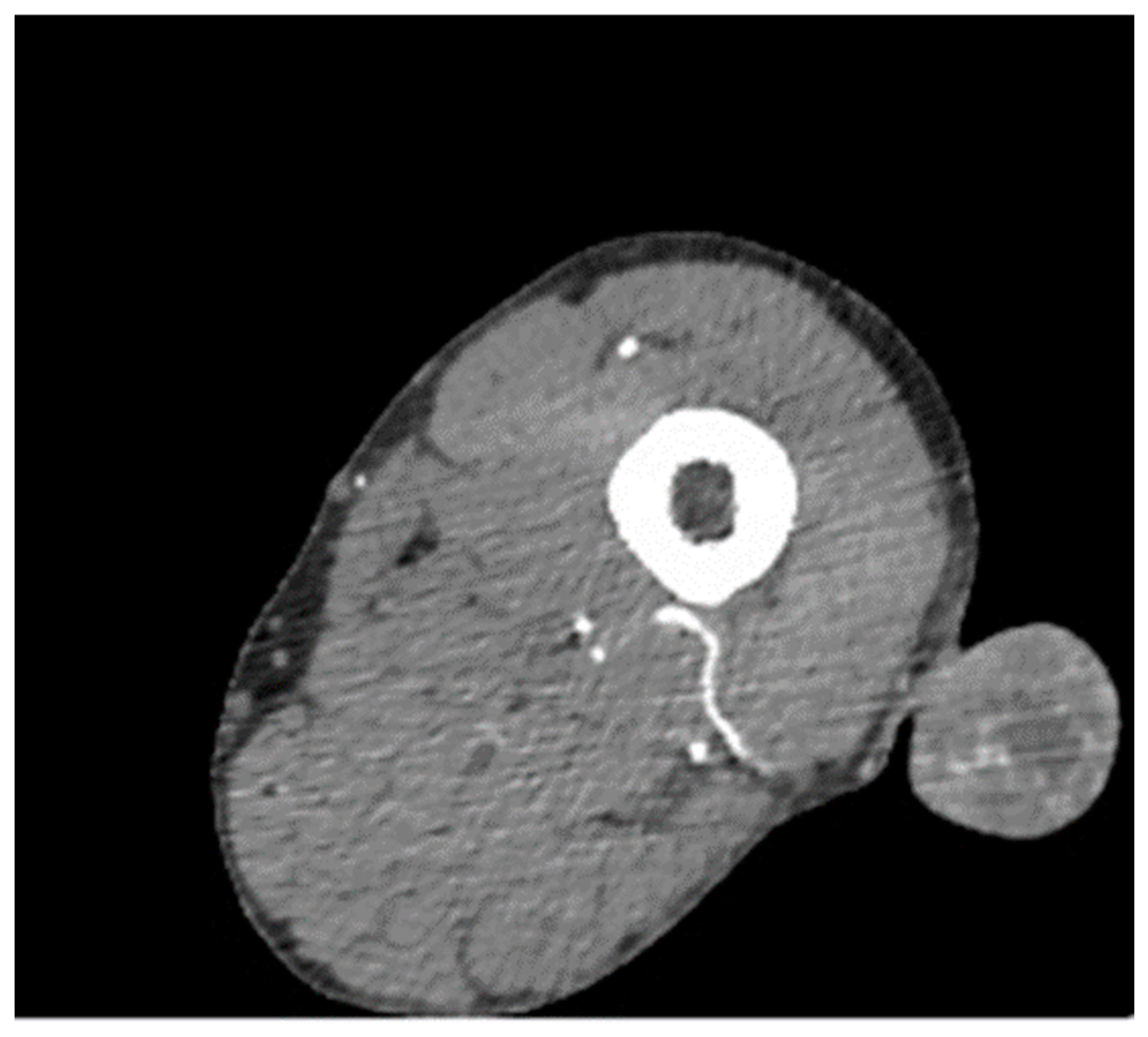 Profunda Femoris Artery