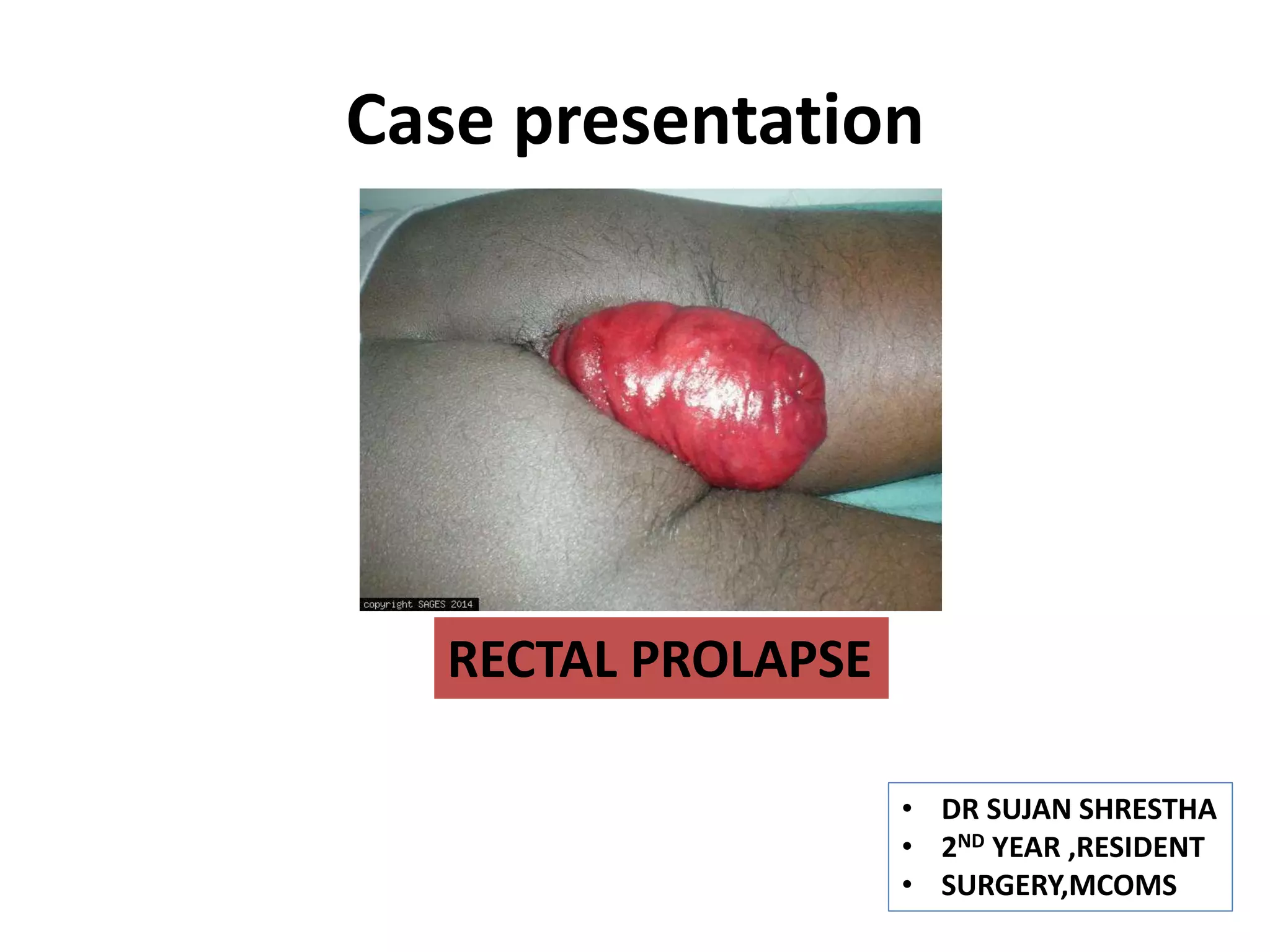 Prolapse Rectal Image